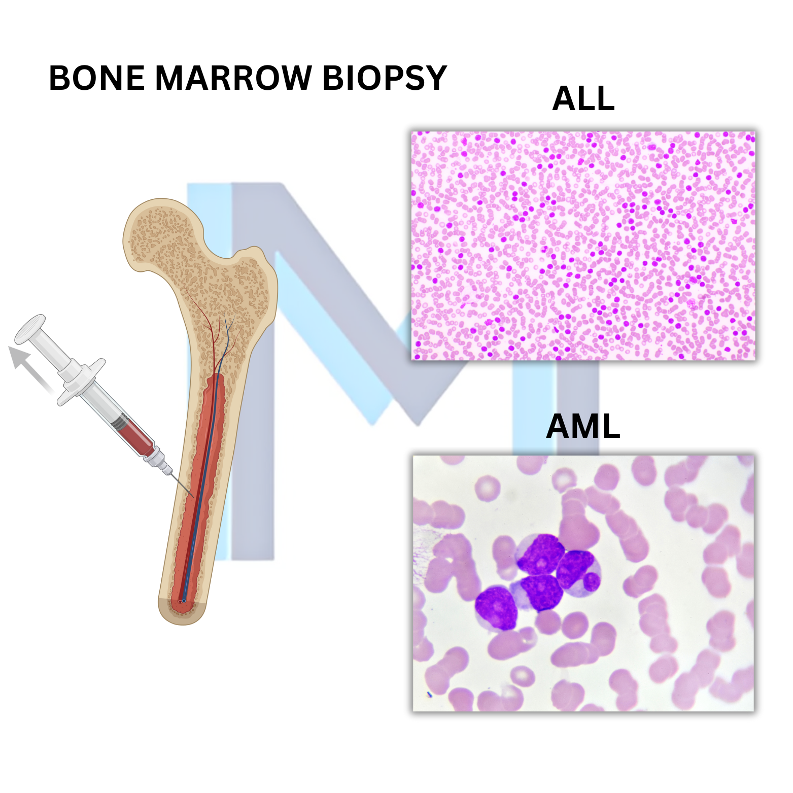 Multiple Myeloma