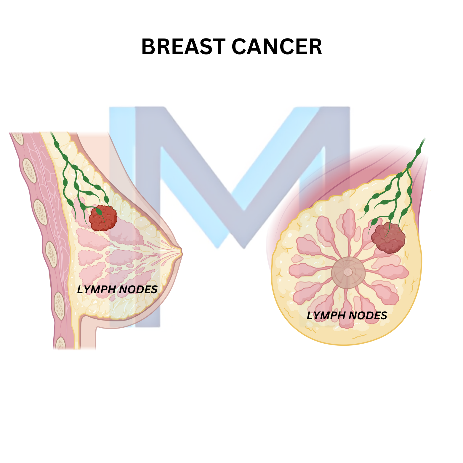 Breast Cancer