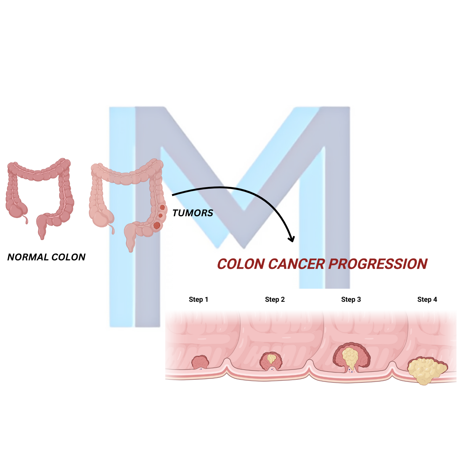 Colorectal Cancer