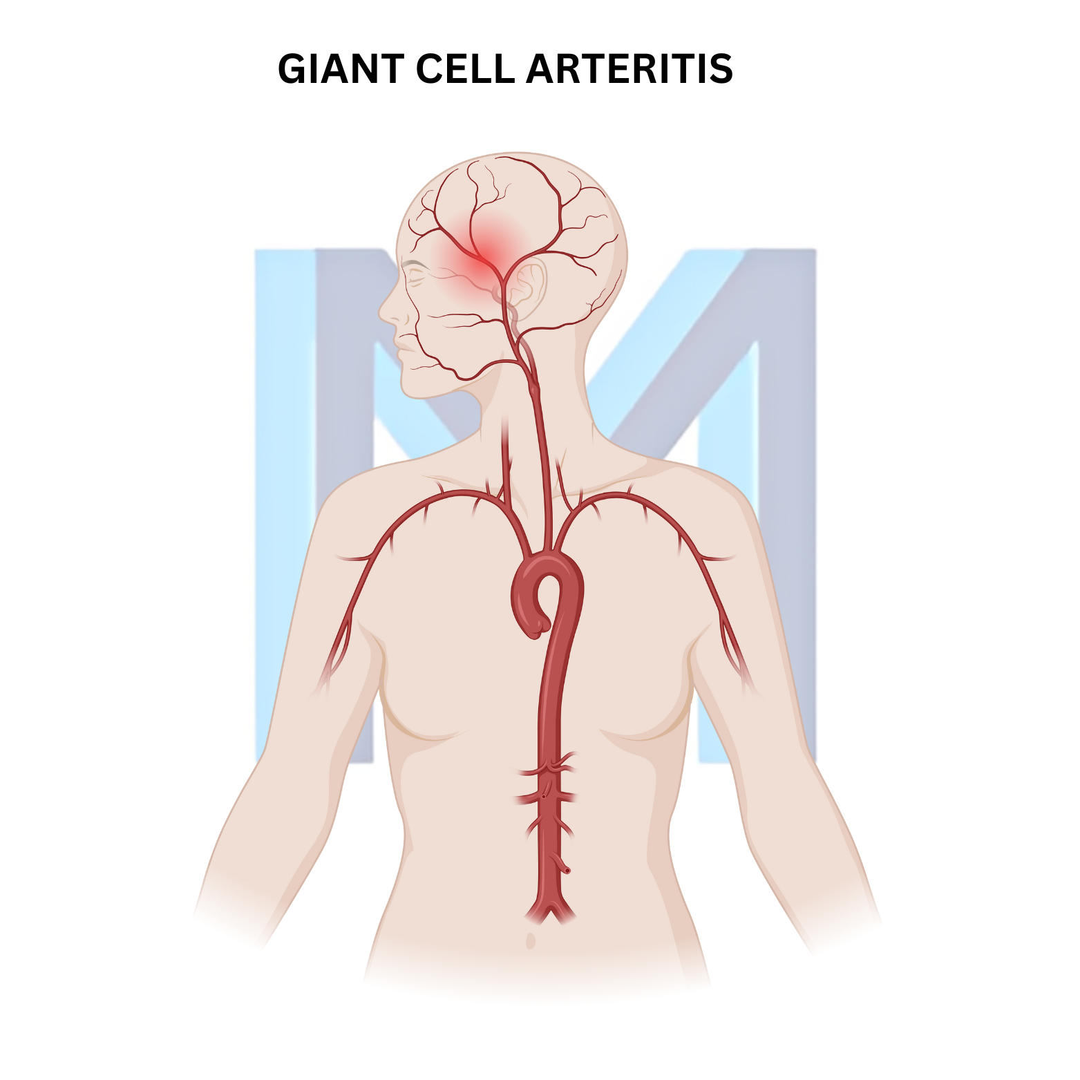 Giant Cell Arteritis (Temporal Arteritis)
