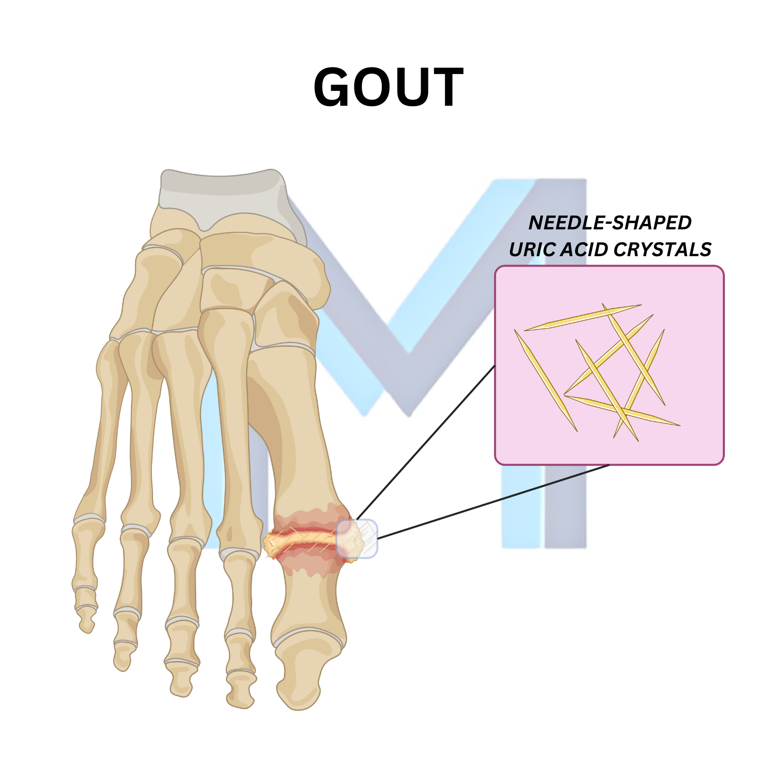 Monosodium urate crystal deposition causing joint inflammation in gout