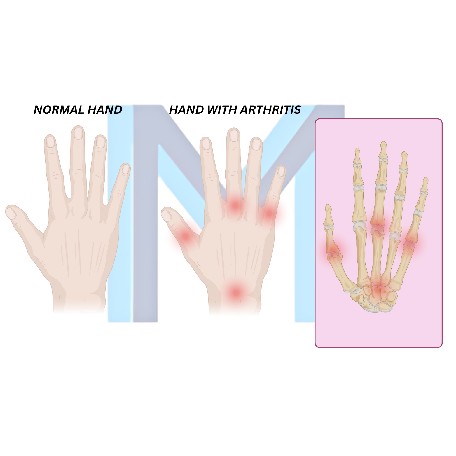 Osteoarthritis
