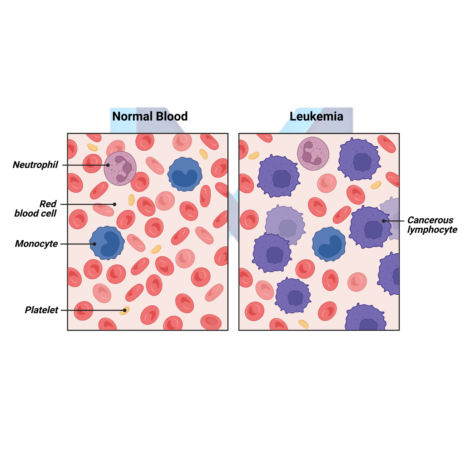 Acute Myeloid Leukemia (AML)