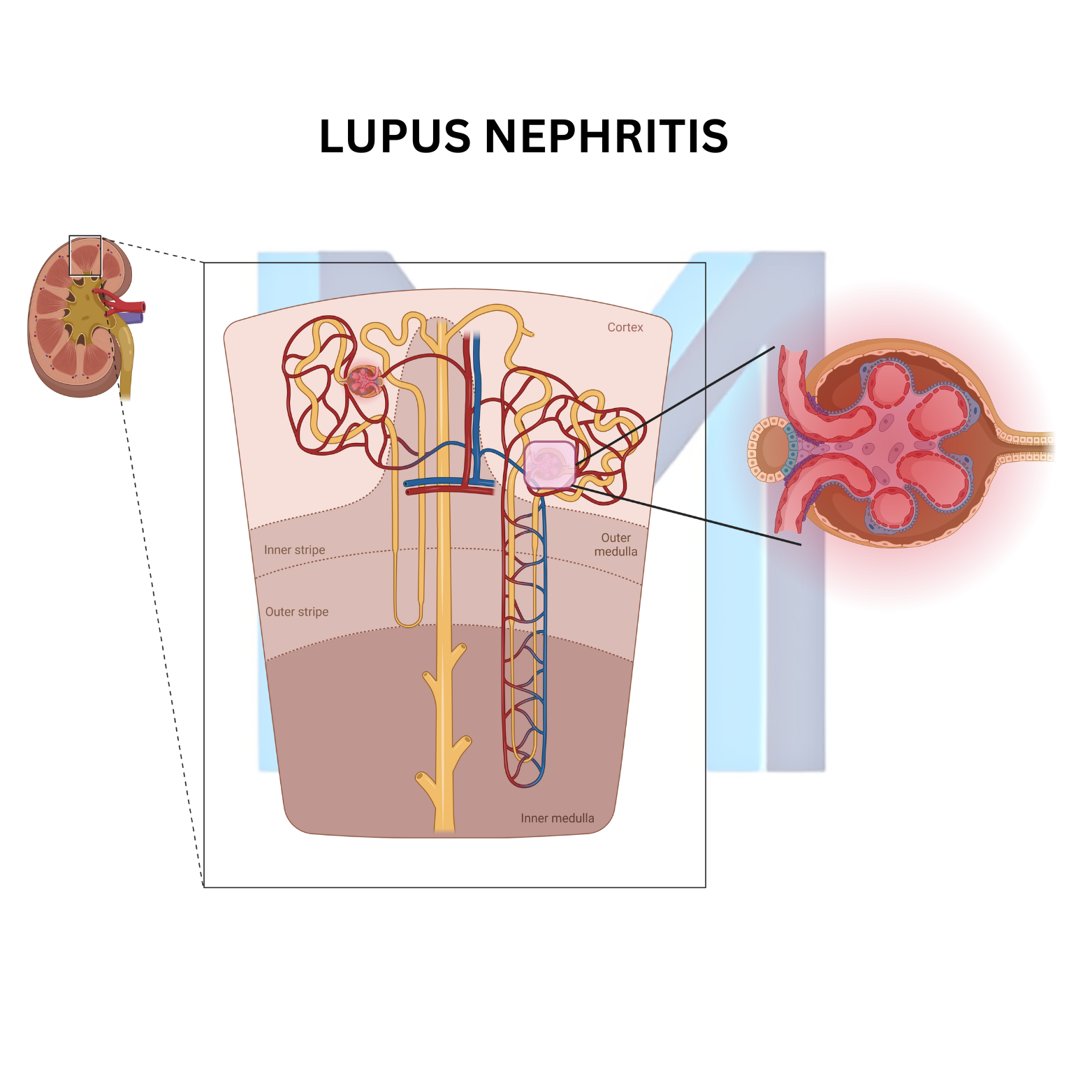 Systemic Lupus Erythematosus (SLE)