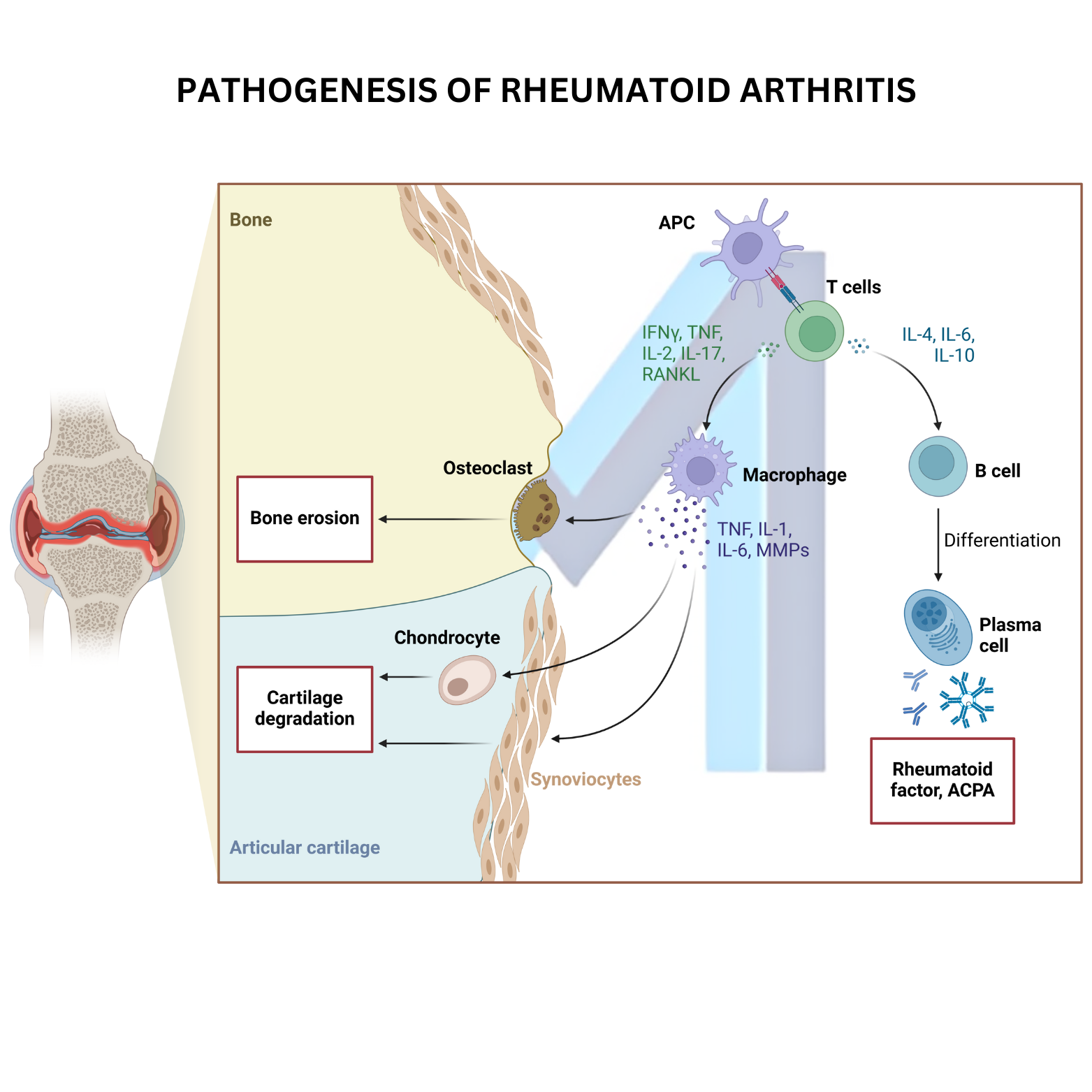 Rheumatoid Arthritis