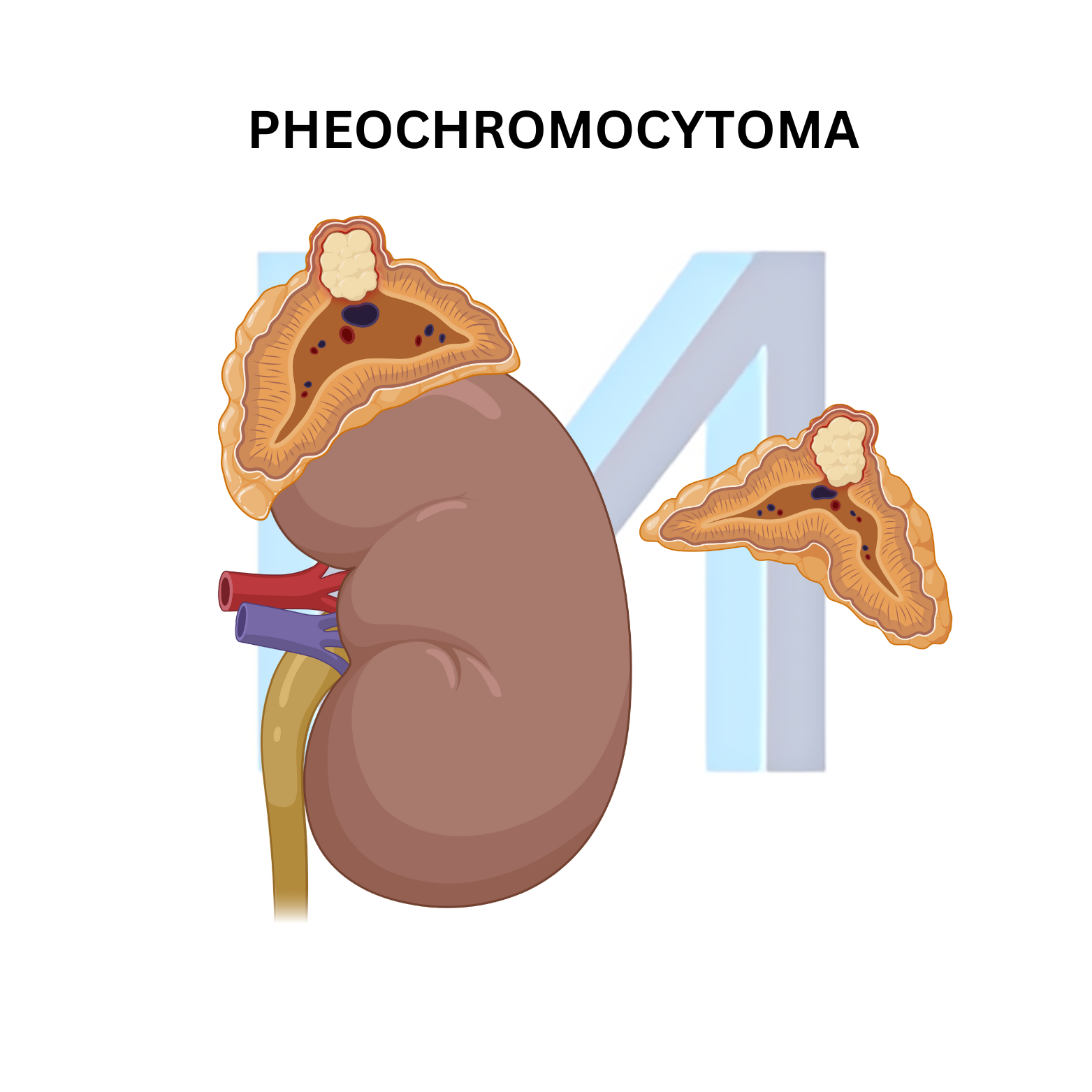 Pheochromocytoma