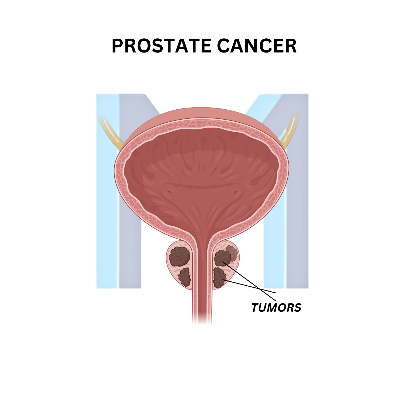 Prostate adenocarcinoma involving the peripheral zone
