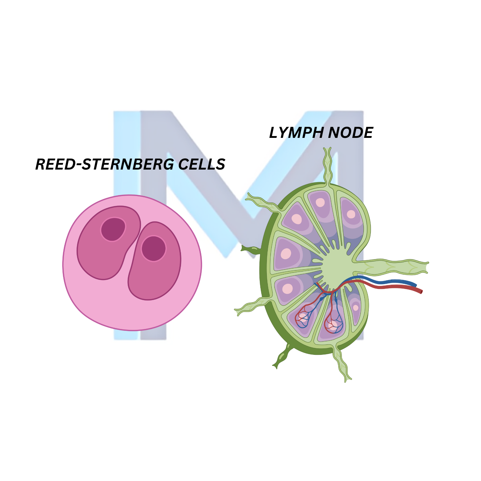 Hodgkin Lymphoma