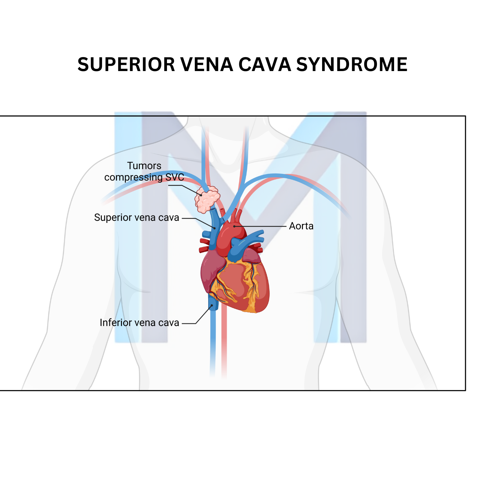 Superior Vena Cava Syndrome