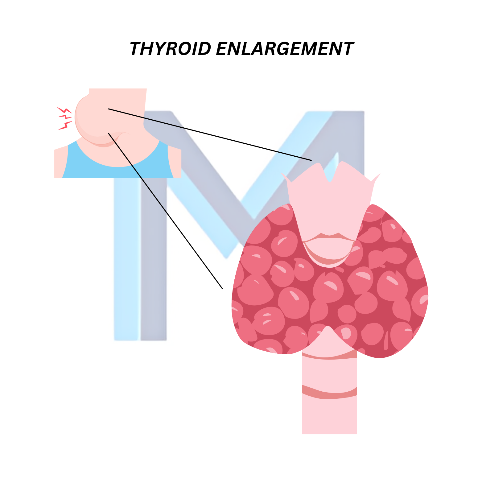 Hashimoto Thyroiditis (Chronic Autoimmune Hypothyroidism)