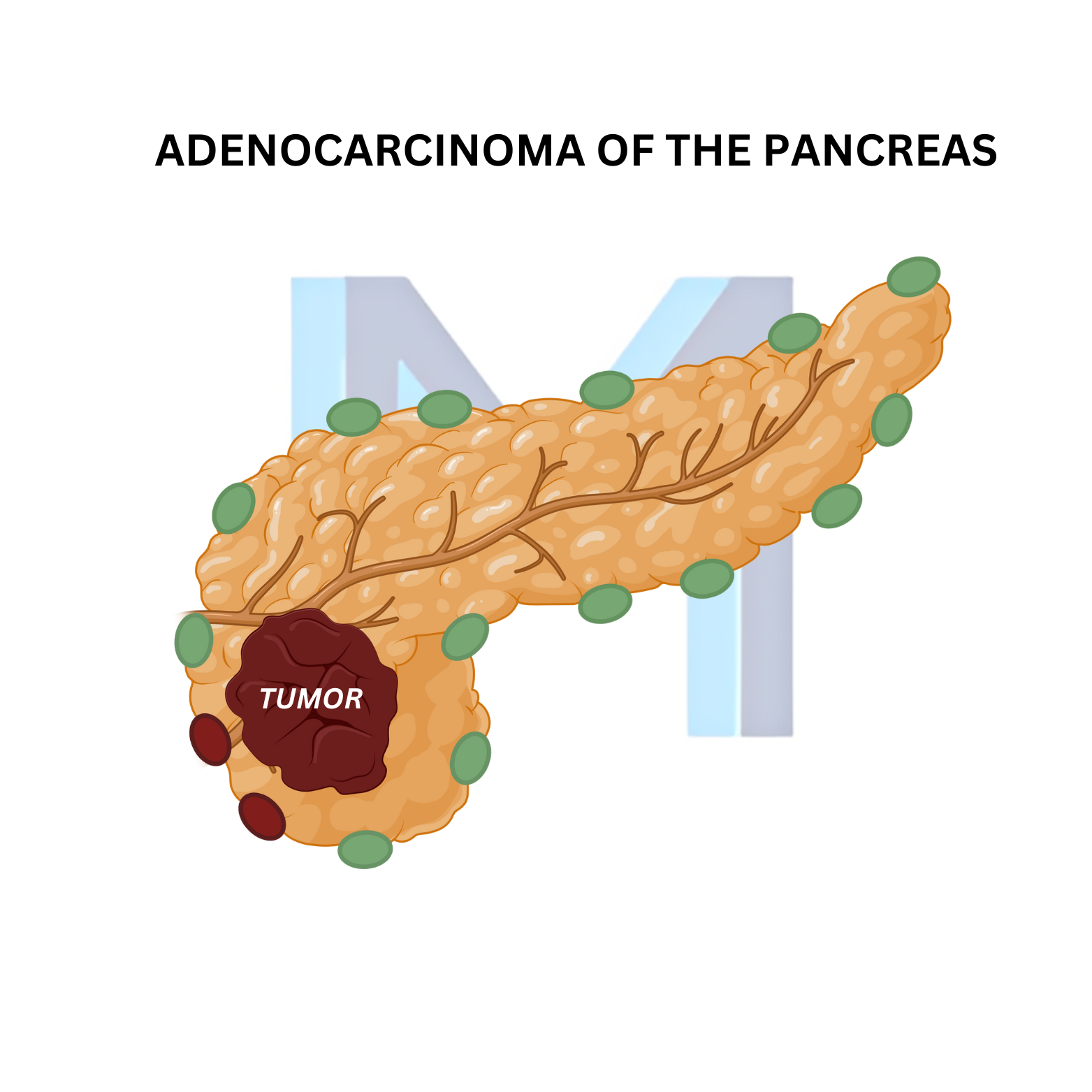 Pancreatic Adenocarcinoma