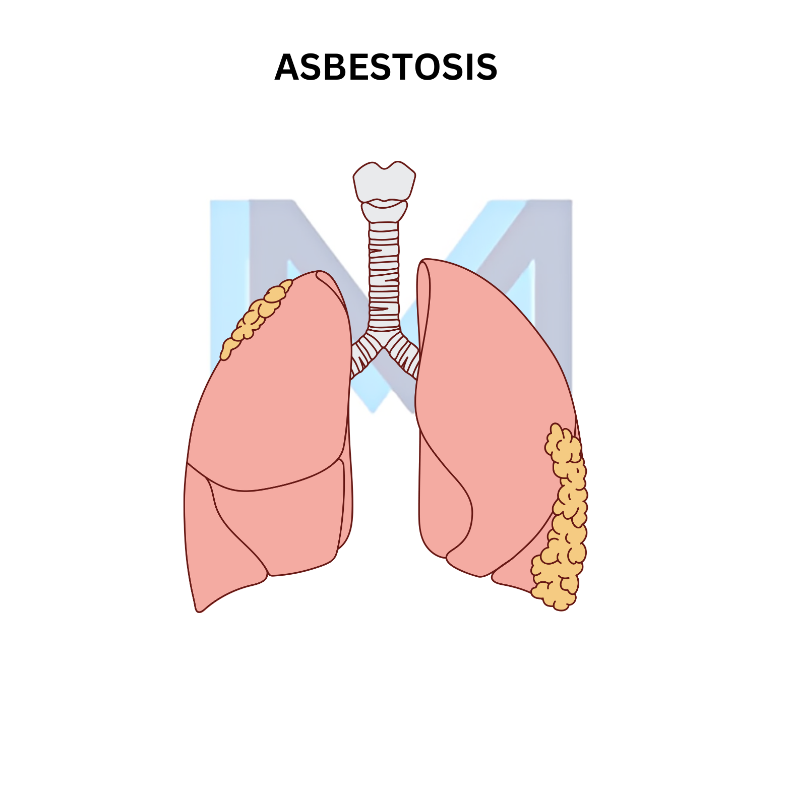 Asbestosis