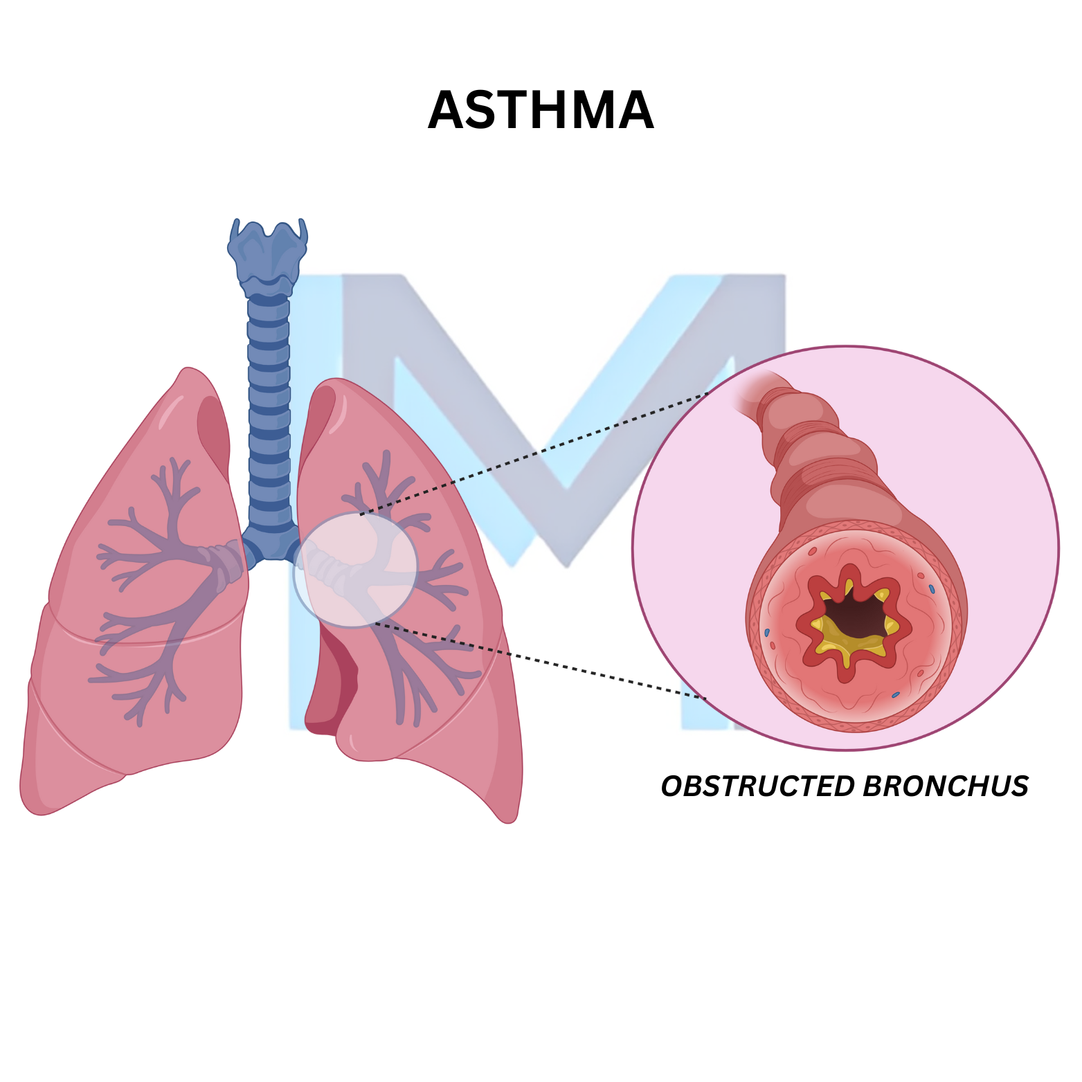 Bronchoconstriction, airway inflammation and mucus plugging in asthma