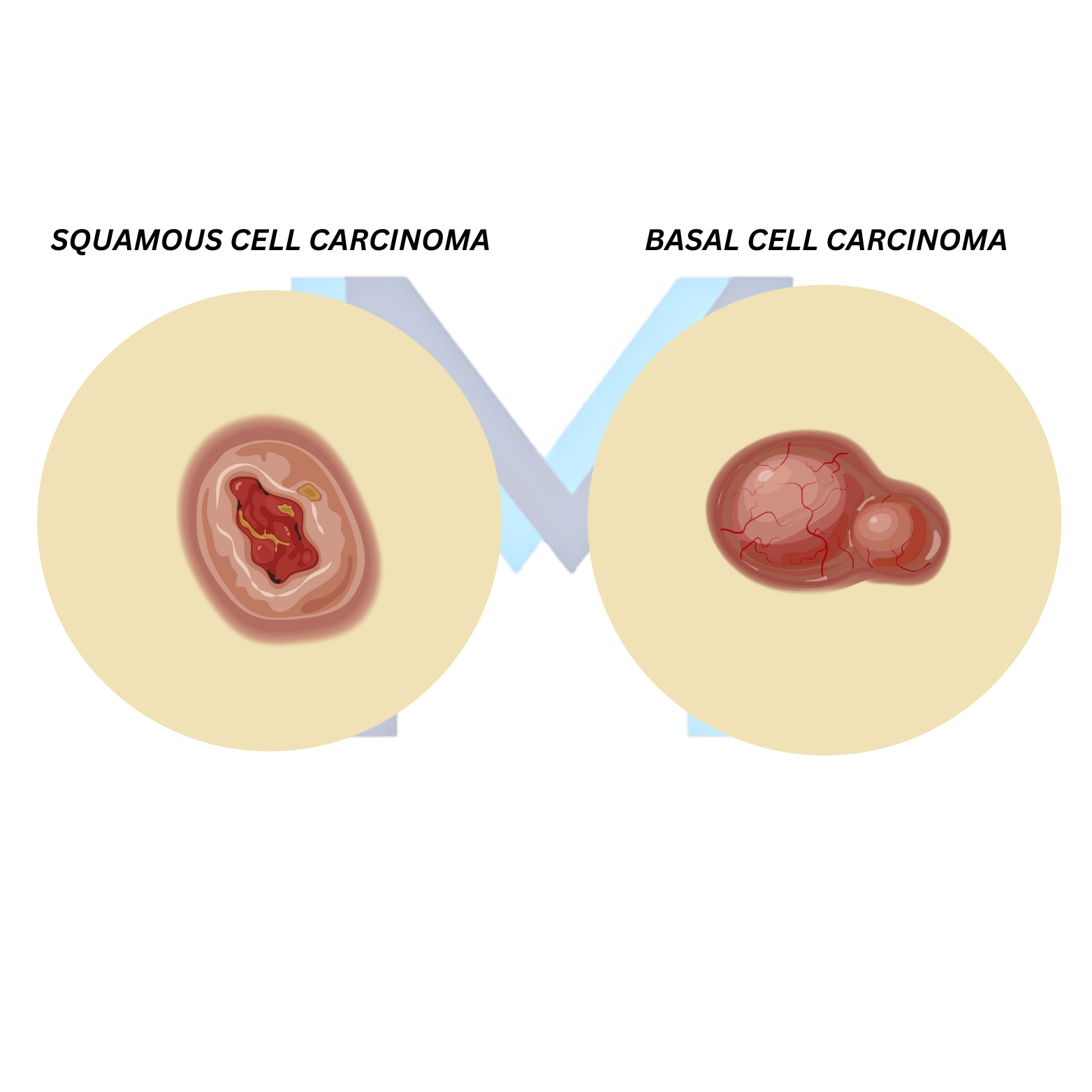 Basal Cell Carcinoma
