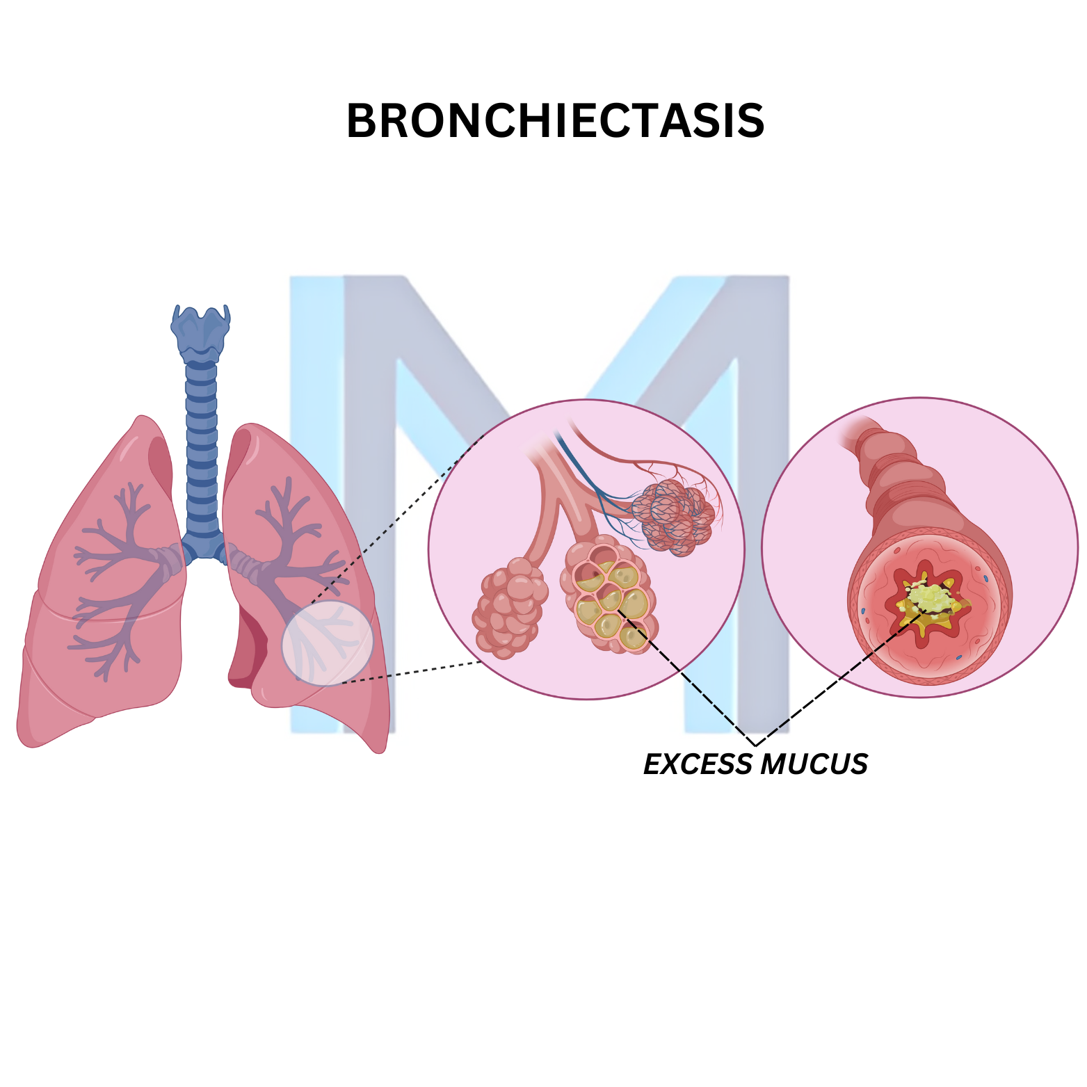 Bronchiectasis