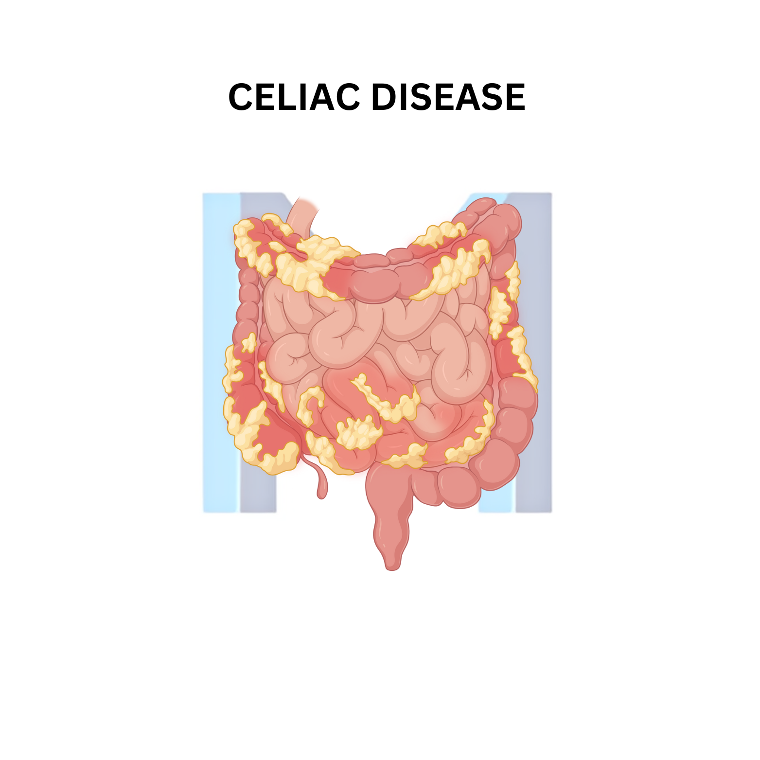 Celiac Disease (Gluten-Sensitive Enteropathy)