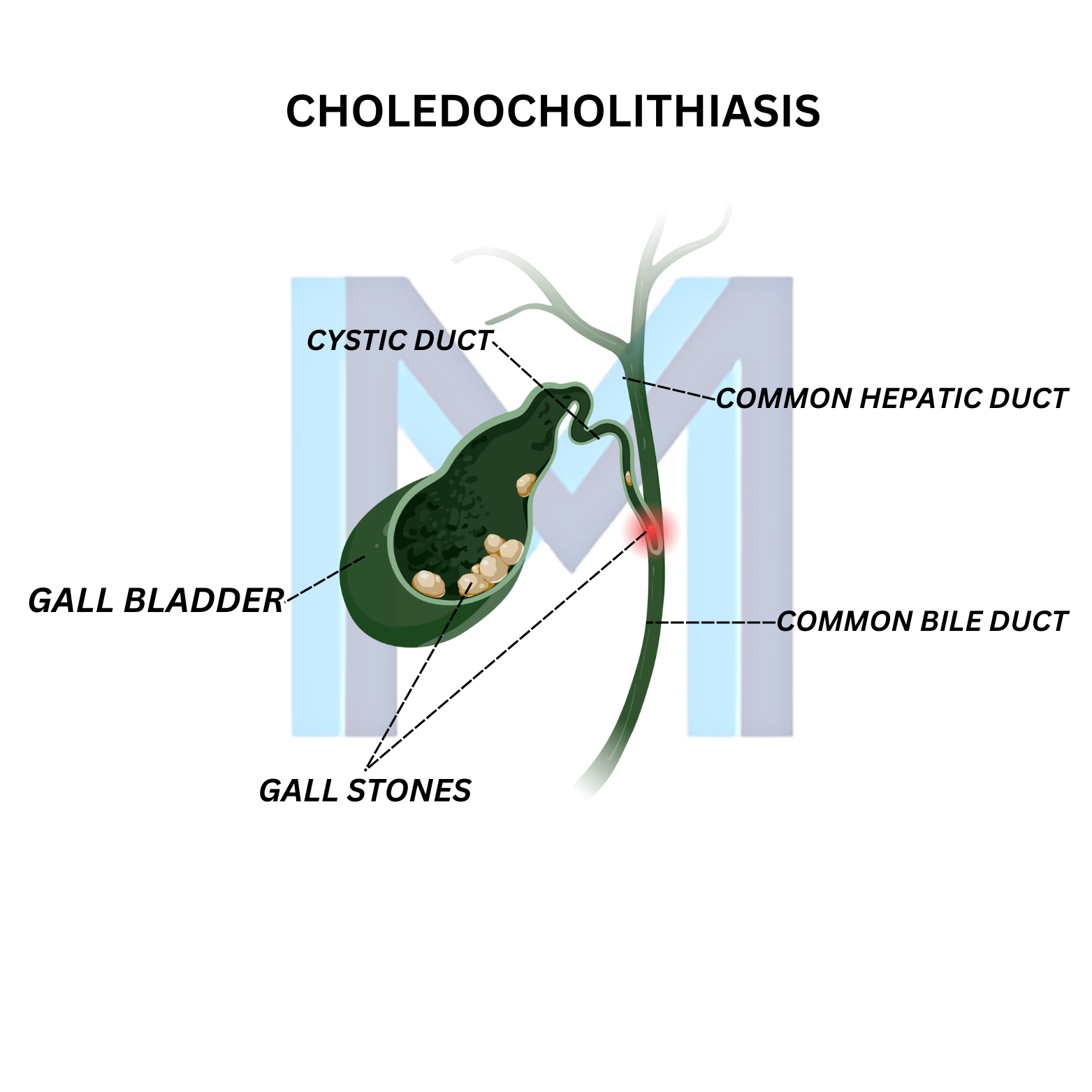 Choledocholithiasis