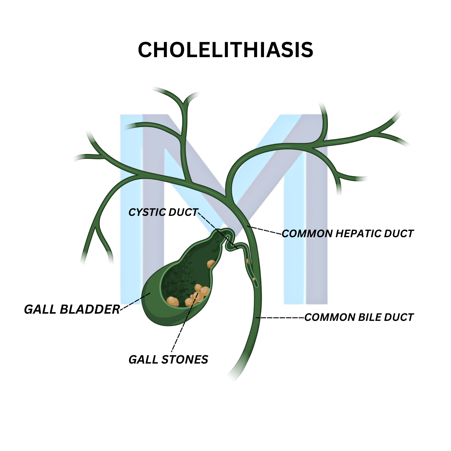 Cholelithiasis (Gallstones)