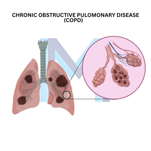 Chronic Obstructive Pulmonary Disease (COPD)