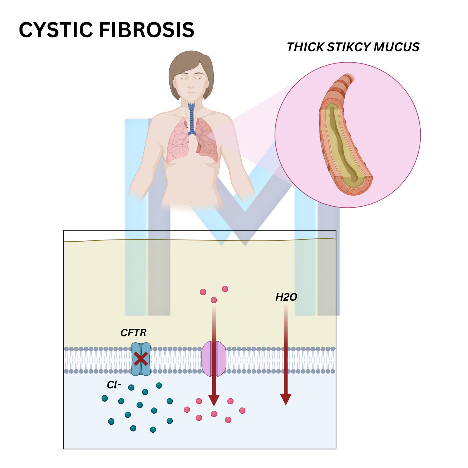 Cystic Fibrosis