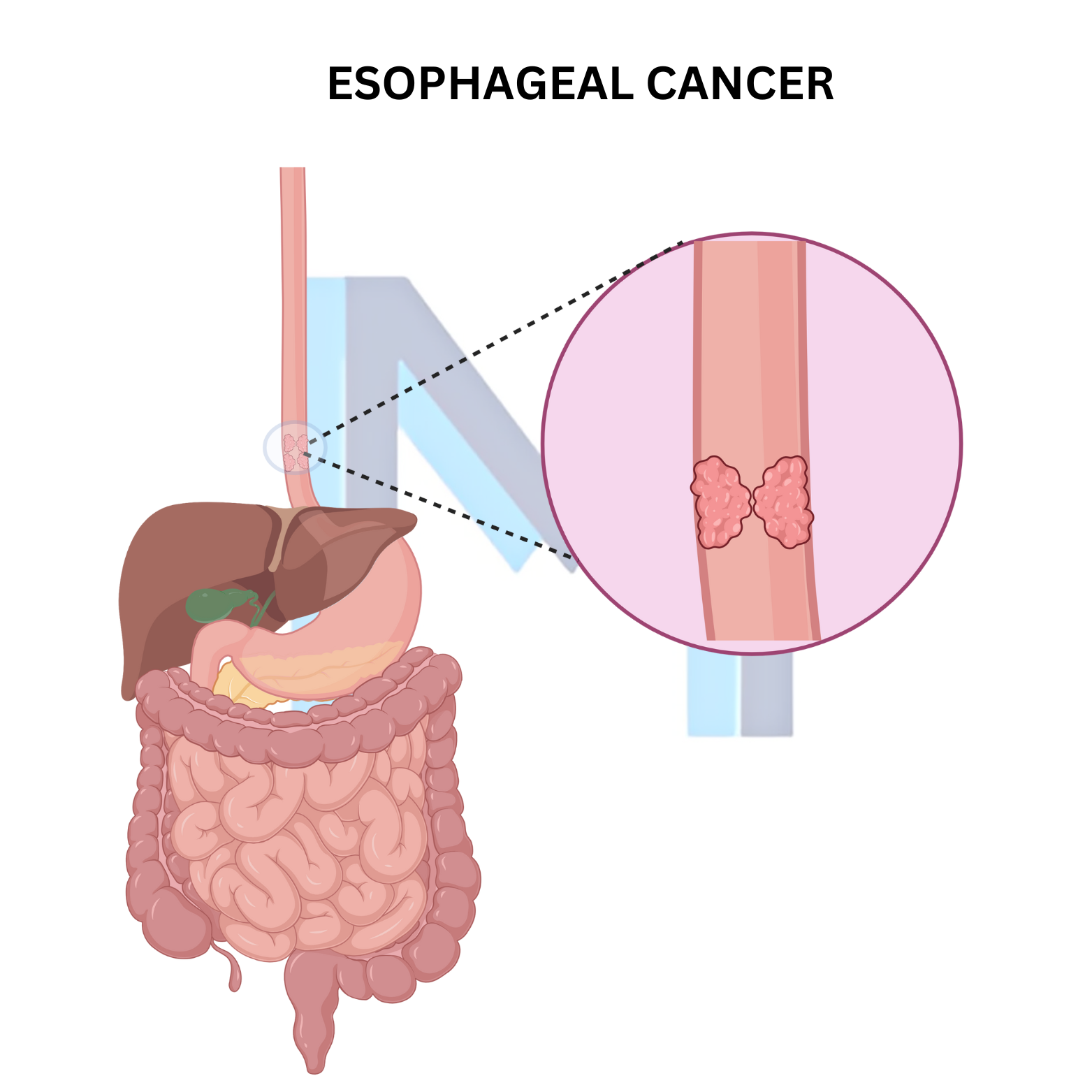 Esophageal Cancer
