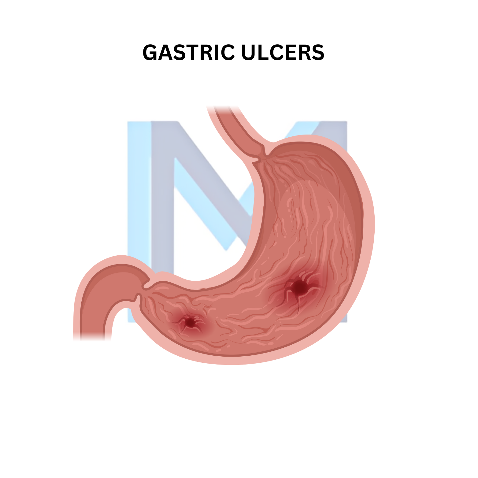 Peptic Ulcer Disease
