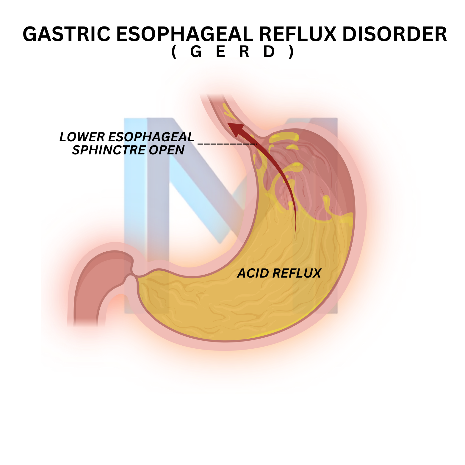 Gastroesophageal Reflux Disease (GERD)