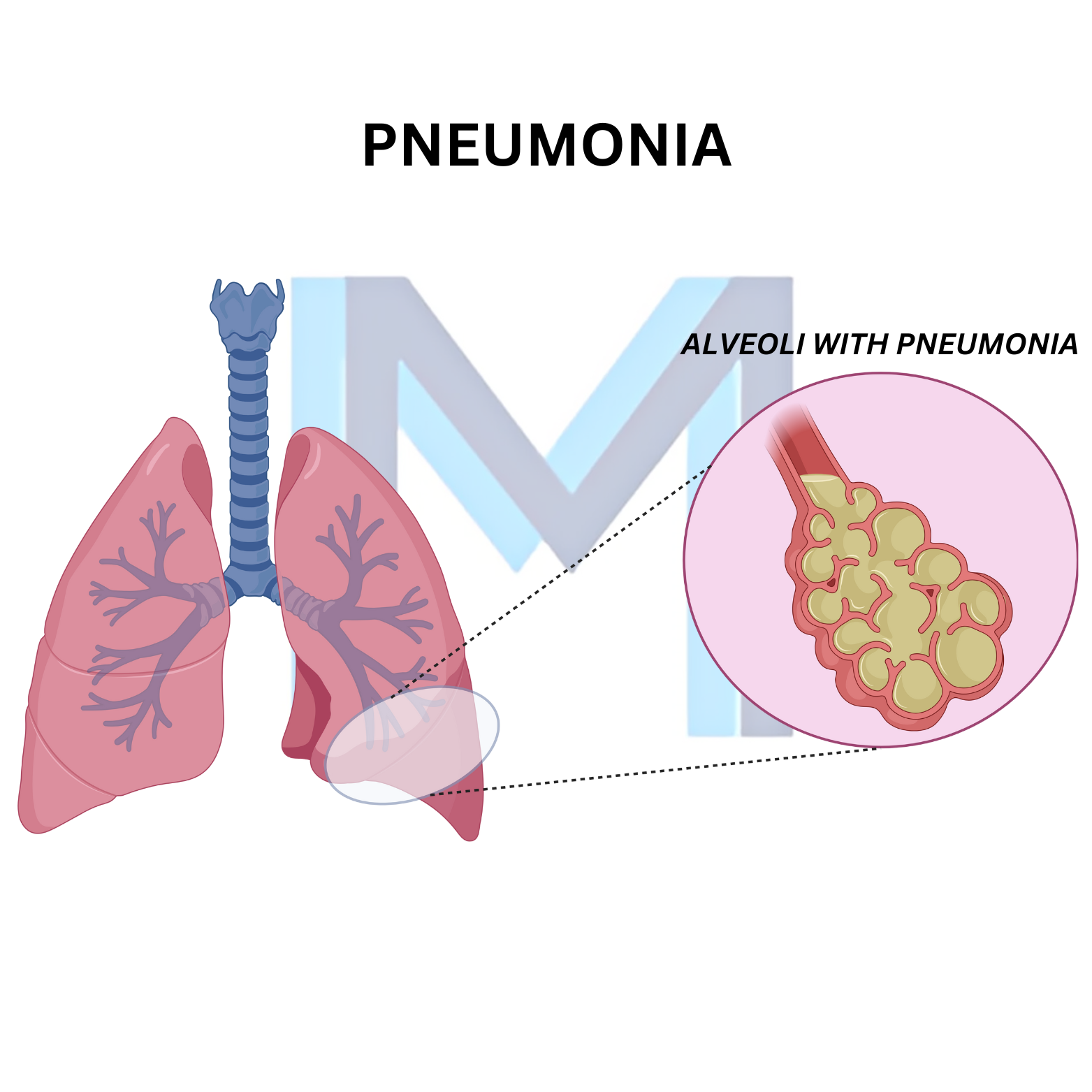 Community-Acquired Pneumonia