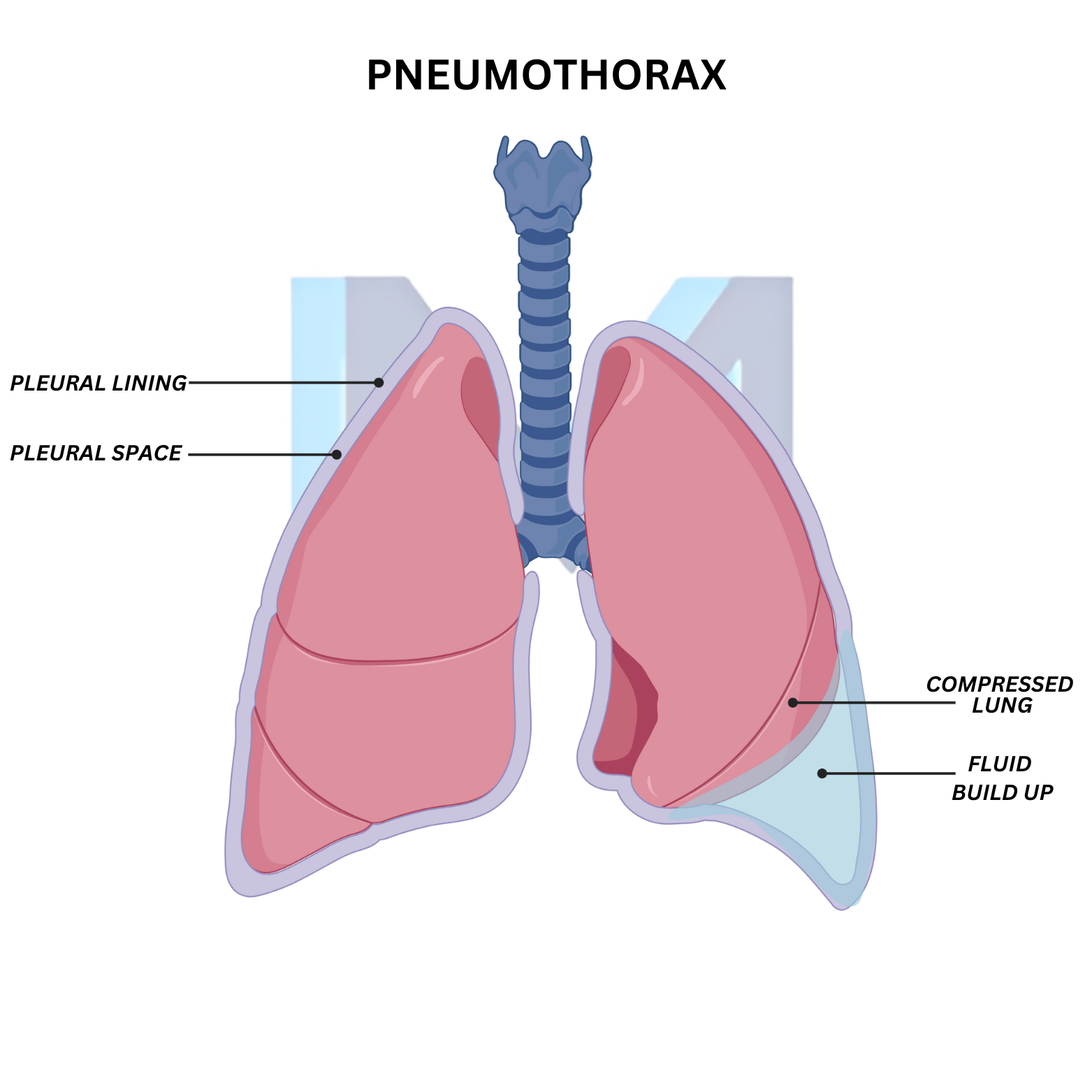 Pneumothorax