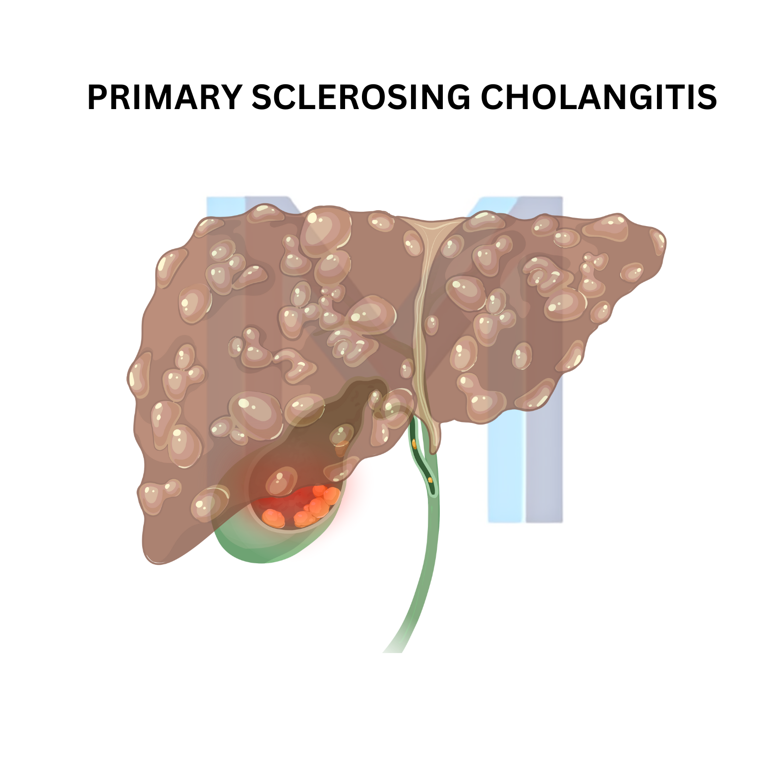Primary Sclerosing Cholangitis
