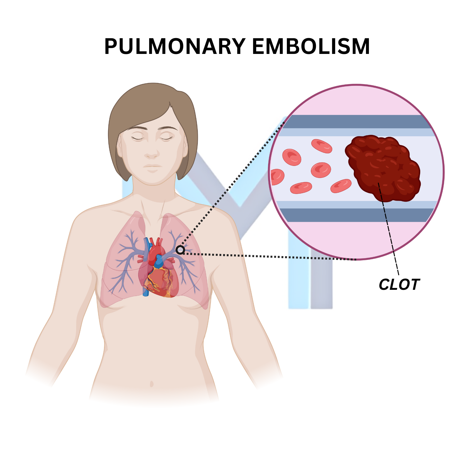 Thromboembolus lodged in a pulmonary artery causing infarction