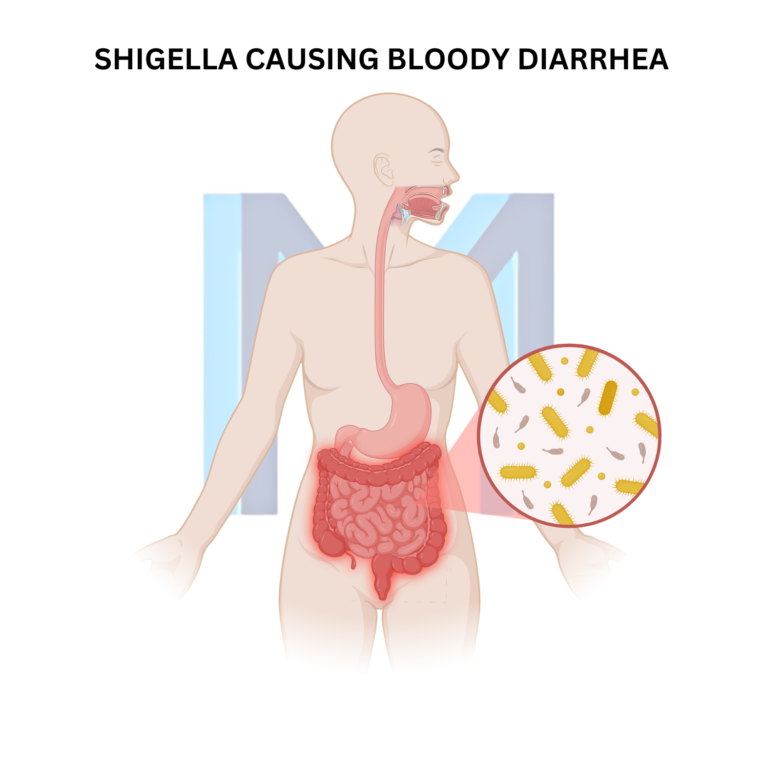Shigellosis (Bacillary Dysentery)