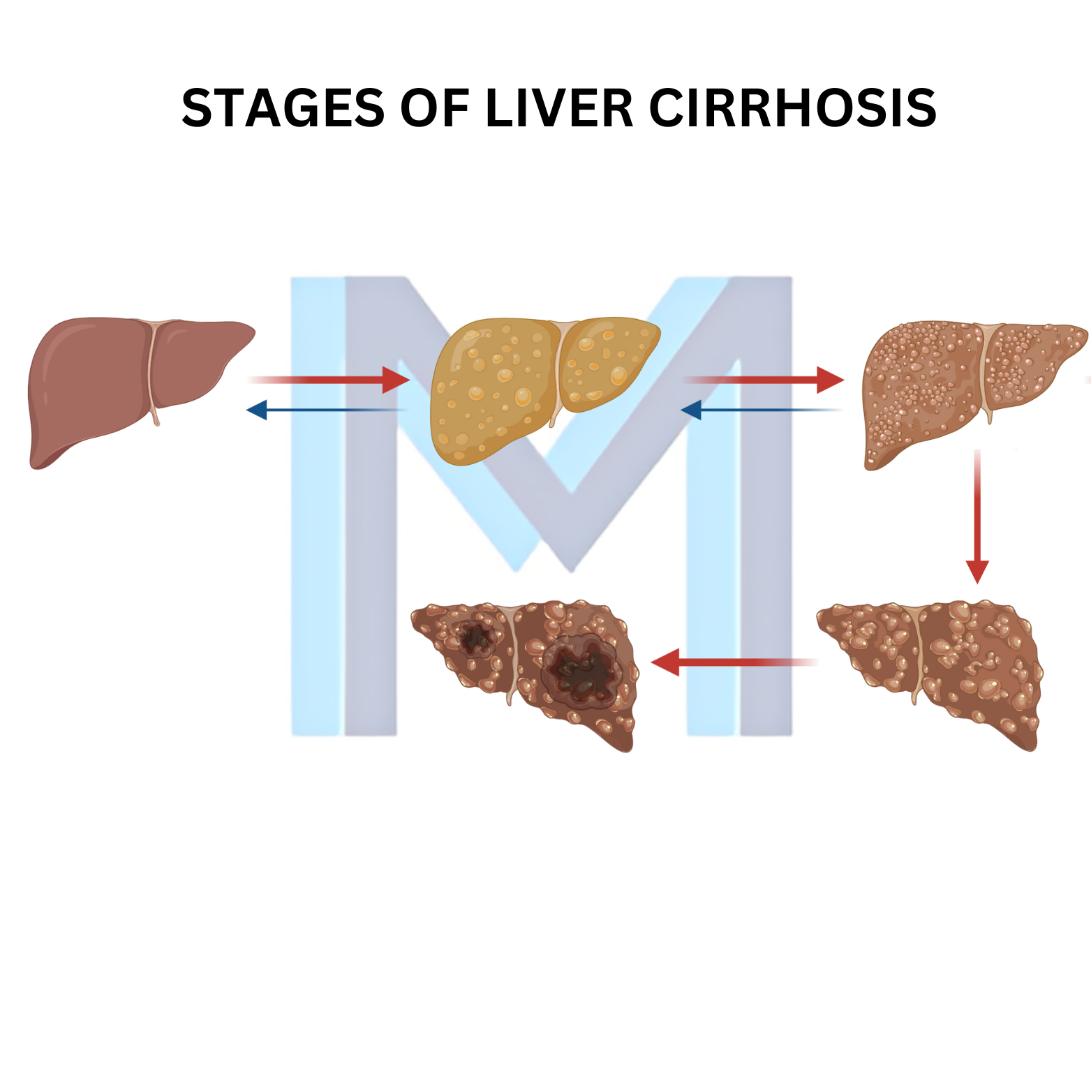 Liver Cirrhosis