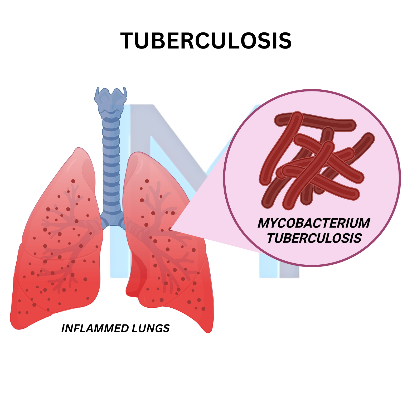 Pulmonary Tuberculosis