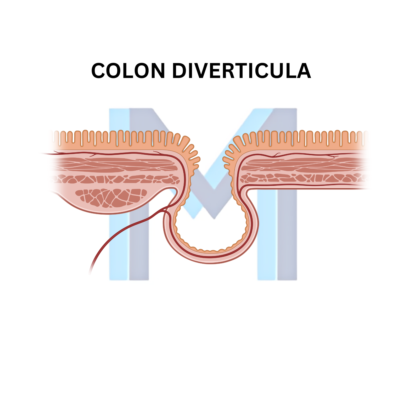 Diverticular Disease and Diverticulitis
