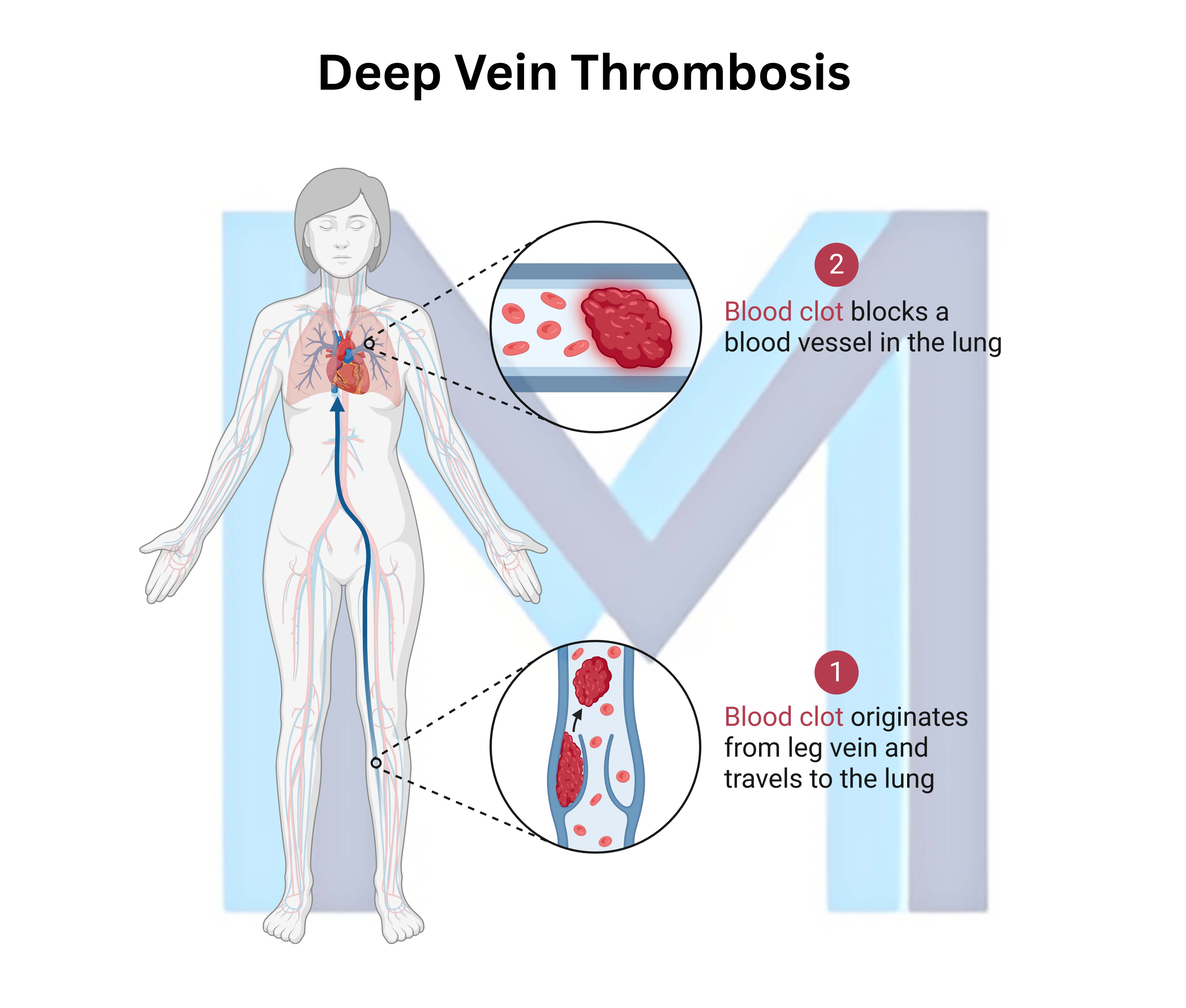 Deep Vein Thrombosis (DVT)