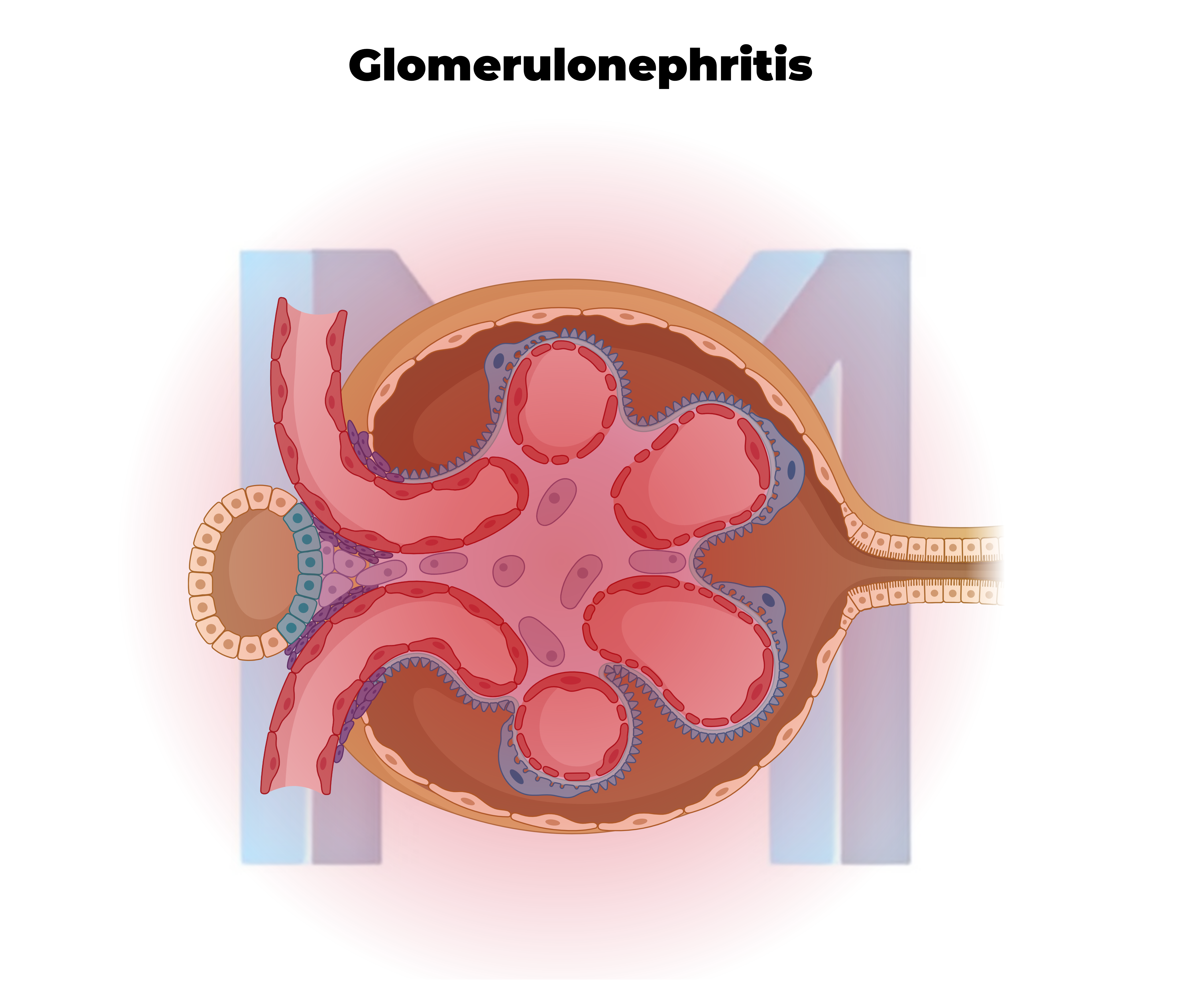 Acute Glomerulonephritis