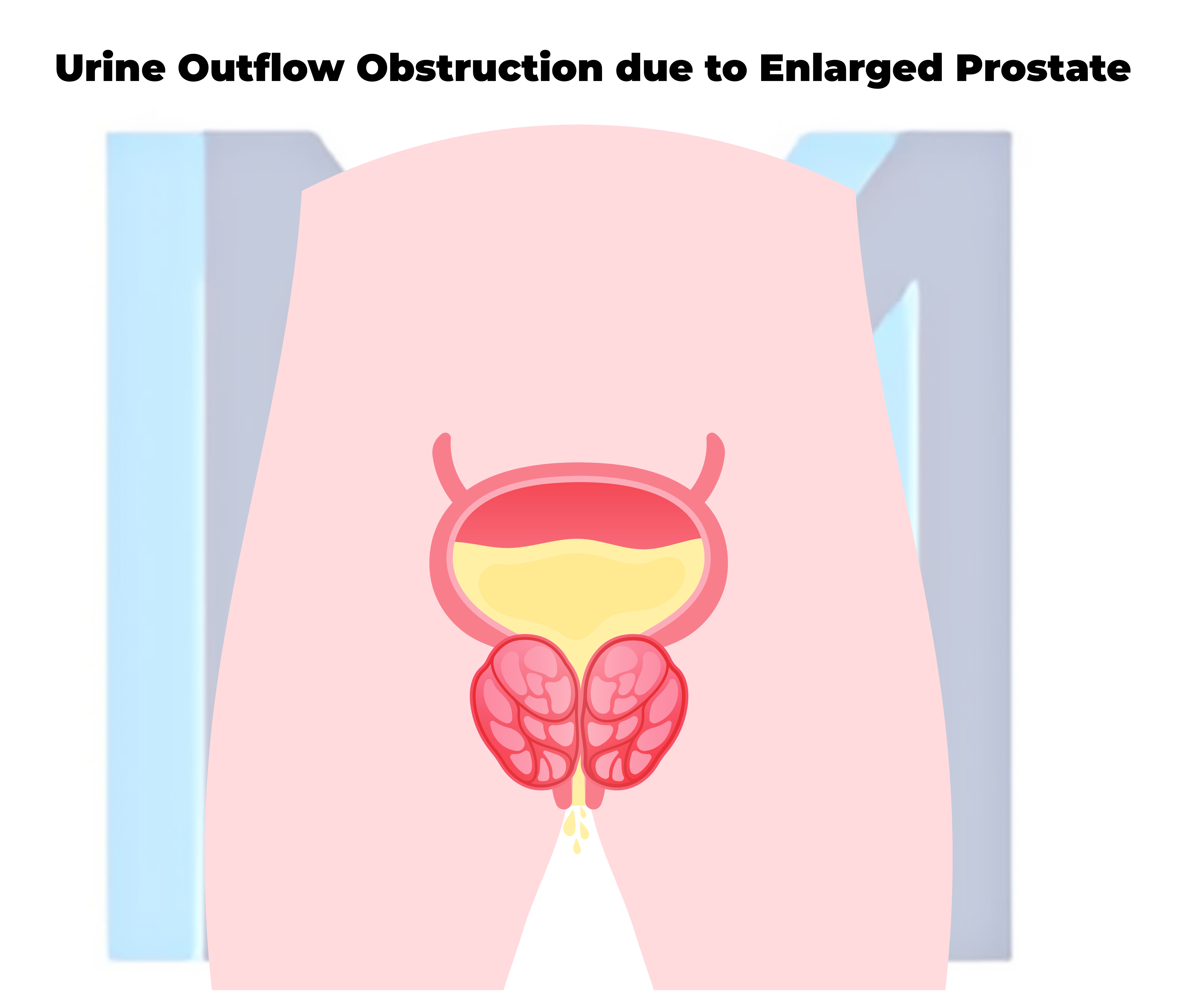 Urinary obstruction from enlarged prostate in BPH