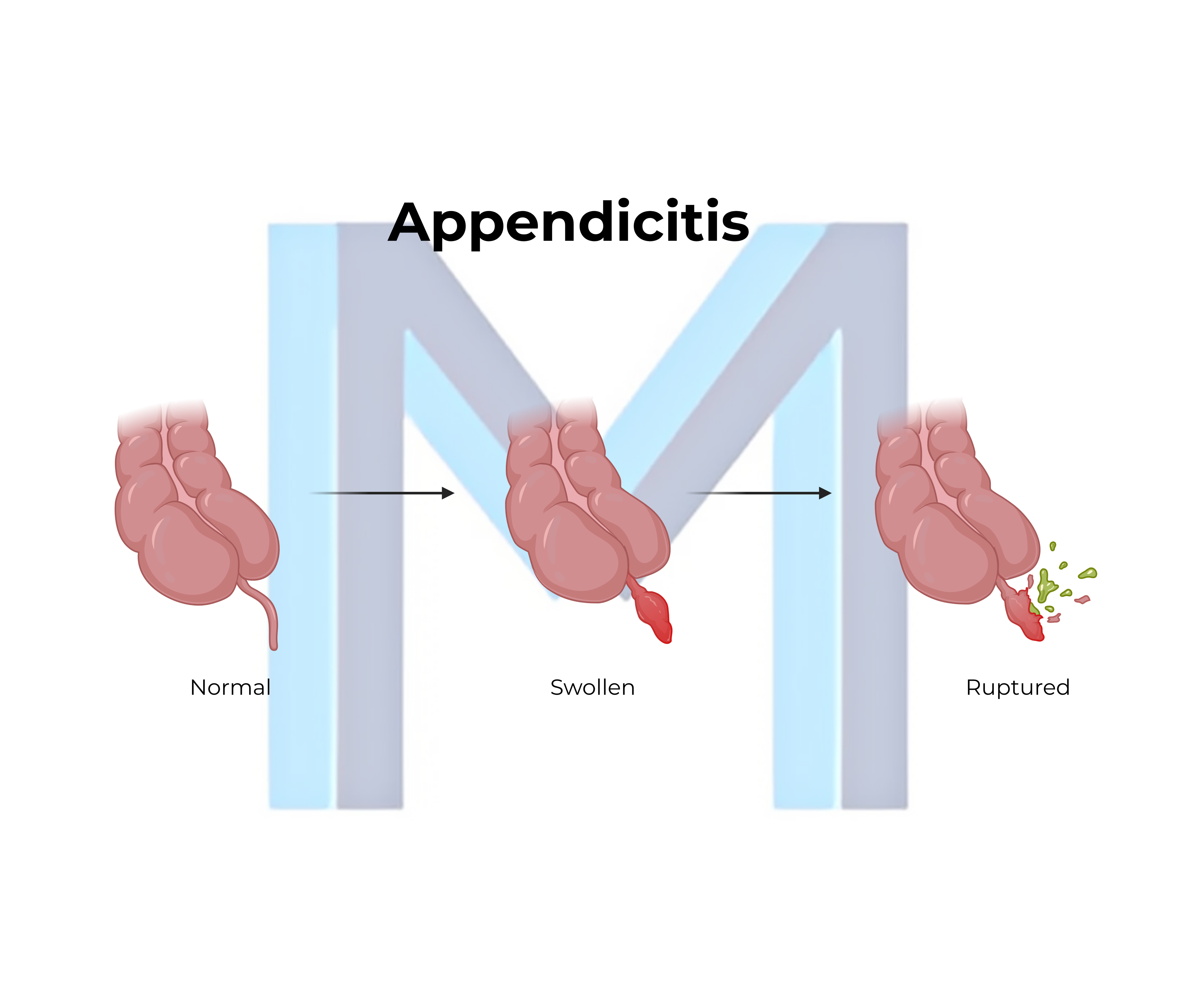 Acute Appendicitis