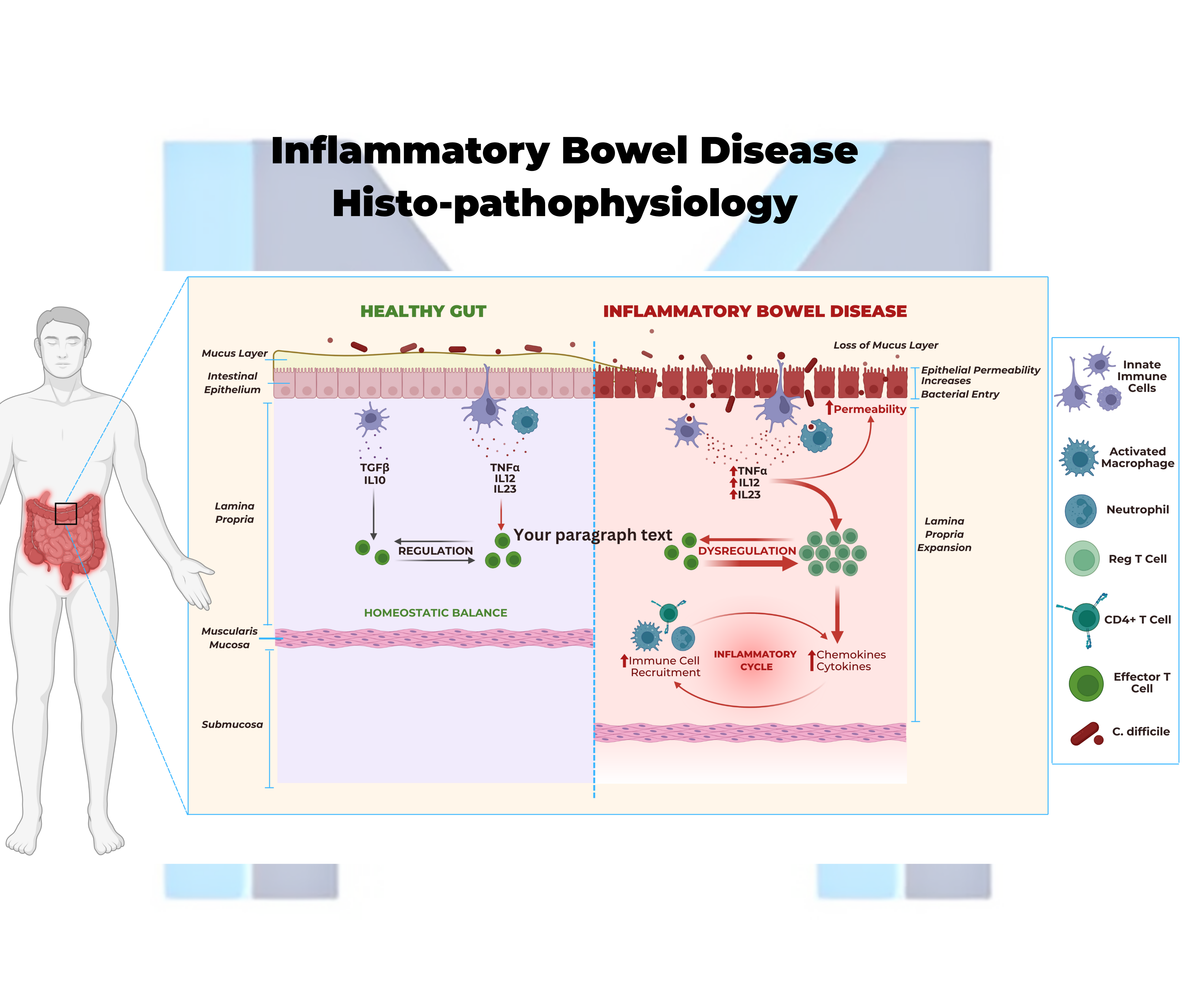 Continuous mucosal inflammation of ulcerative colitis