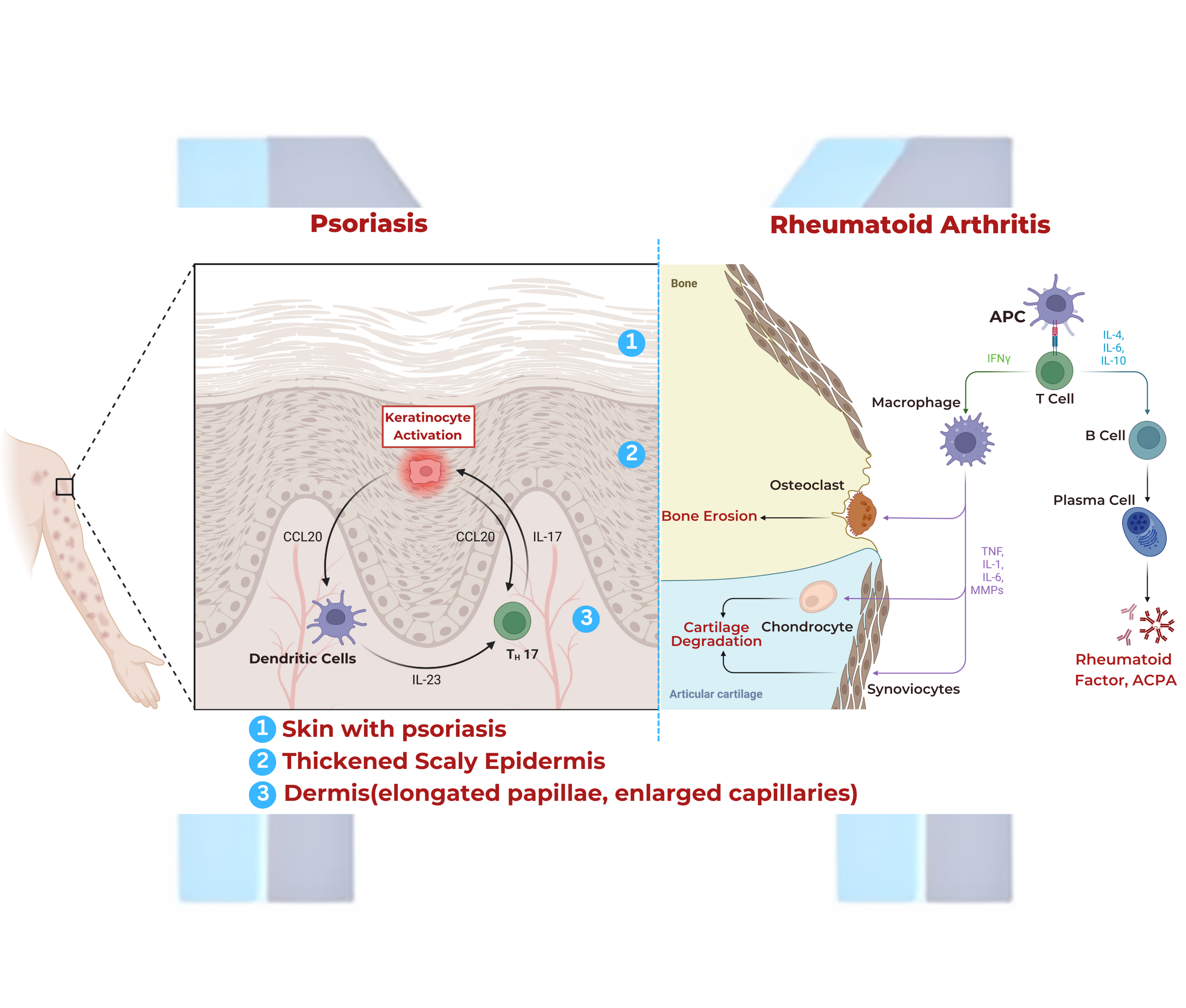 Psoriasis