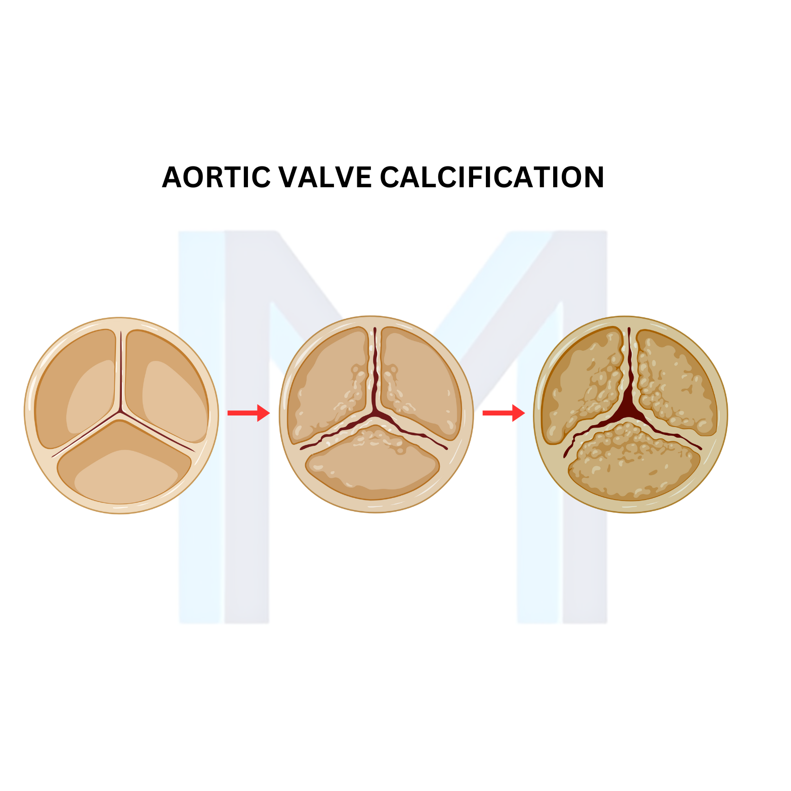 Aortic Stenosis