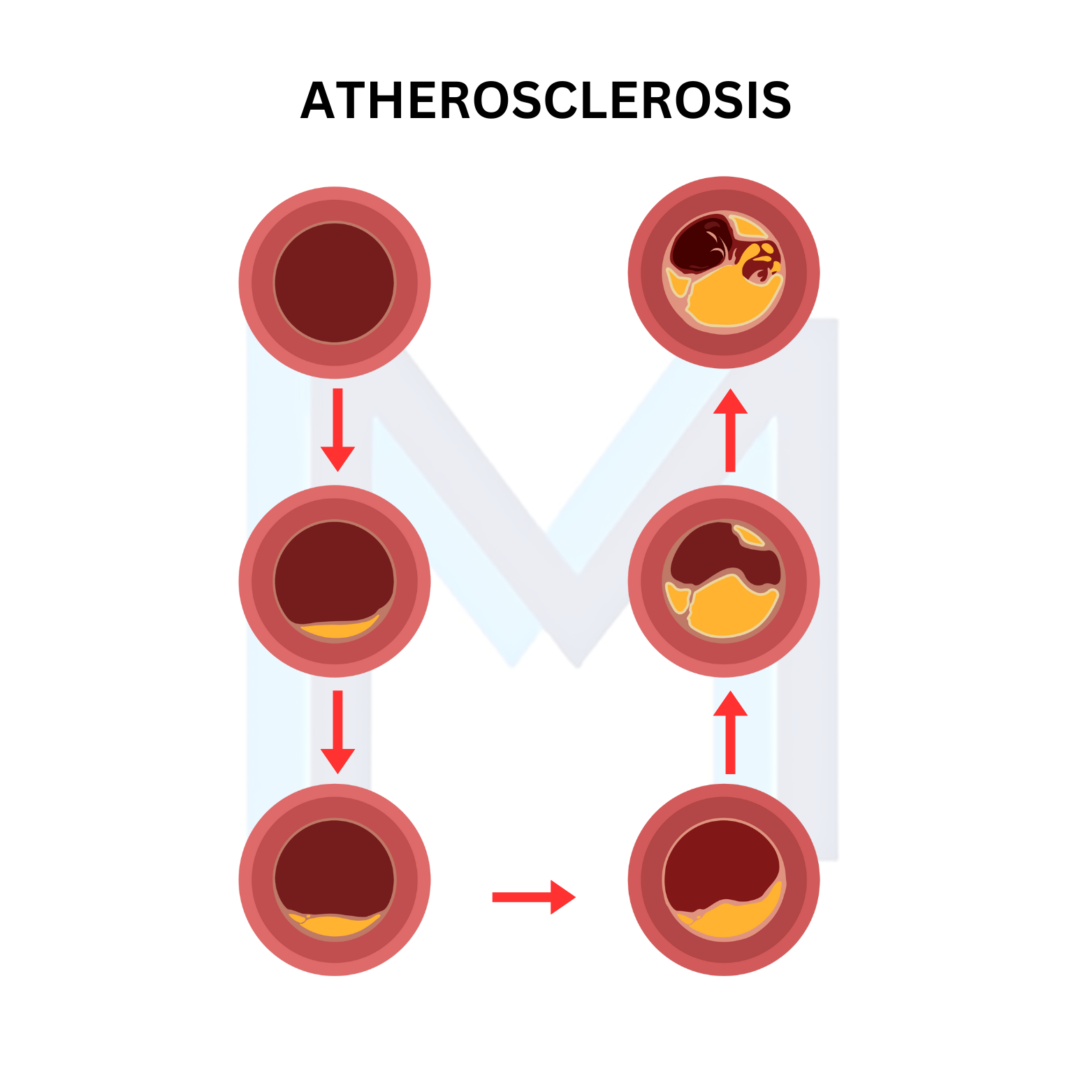 Coronary Atherosclerosis and Stable Angina