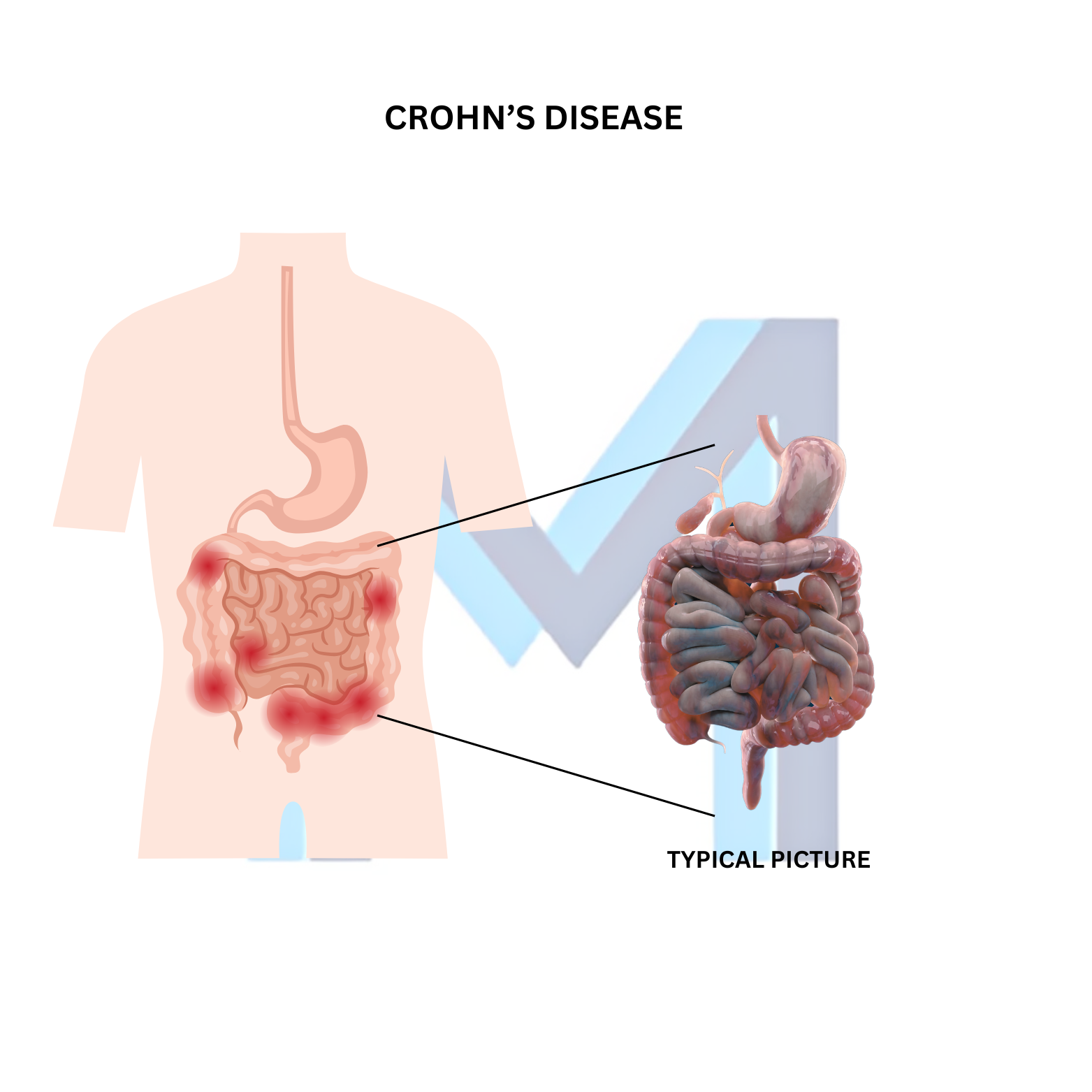 Crohn Disease