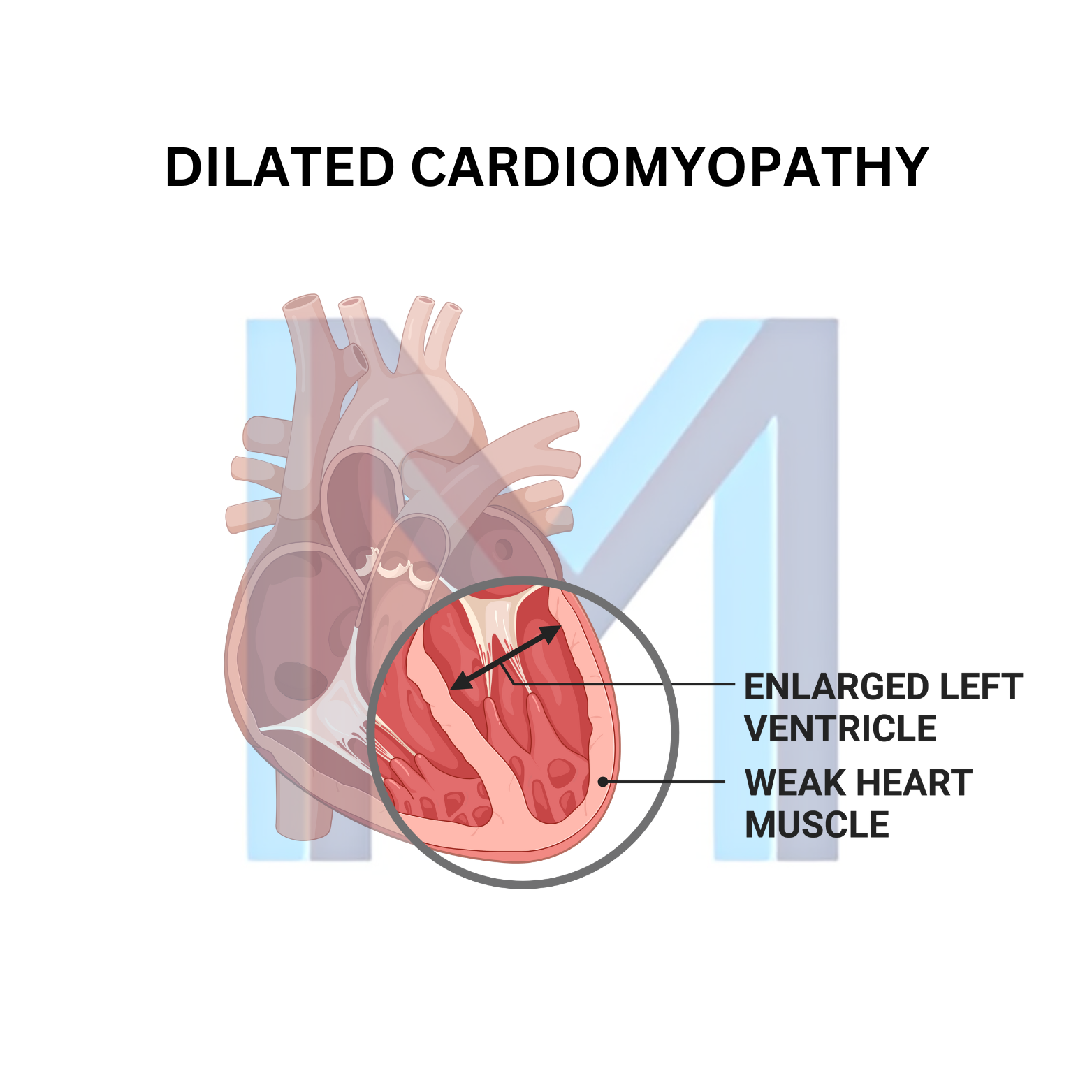 Dilated Cardiomyopathy