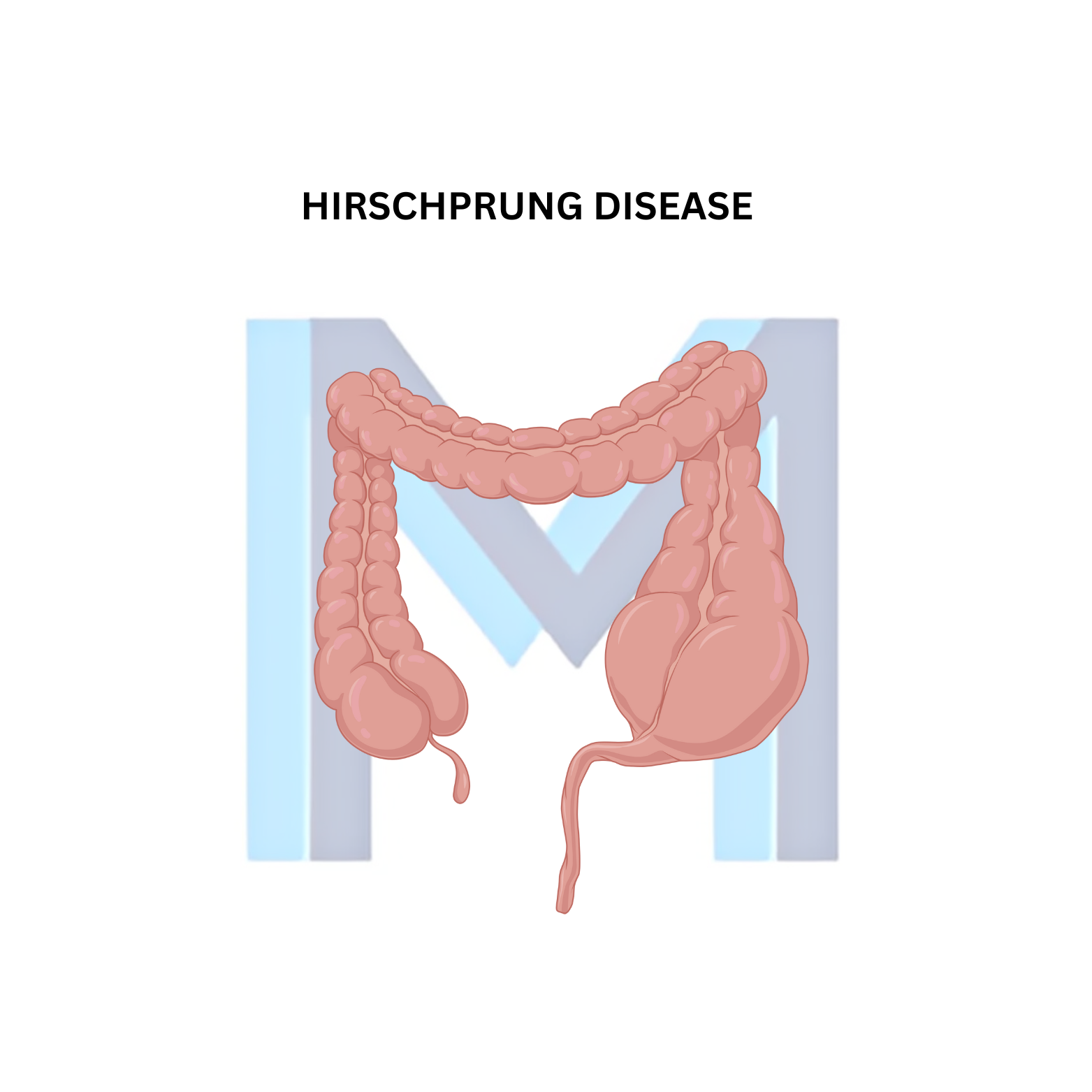 Hirschsprung Disease