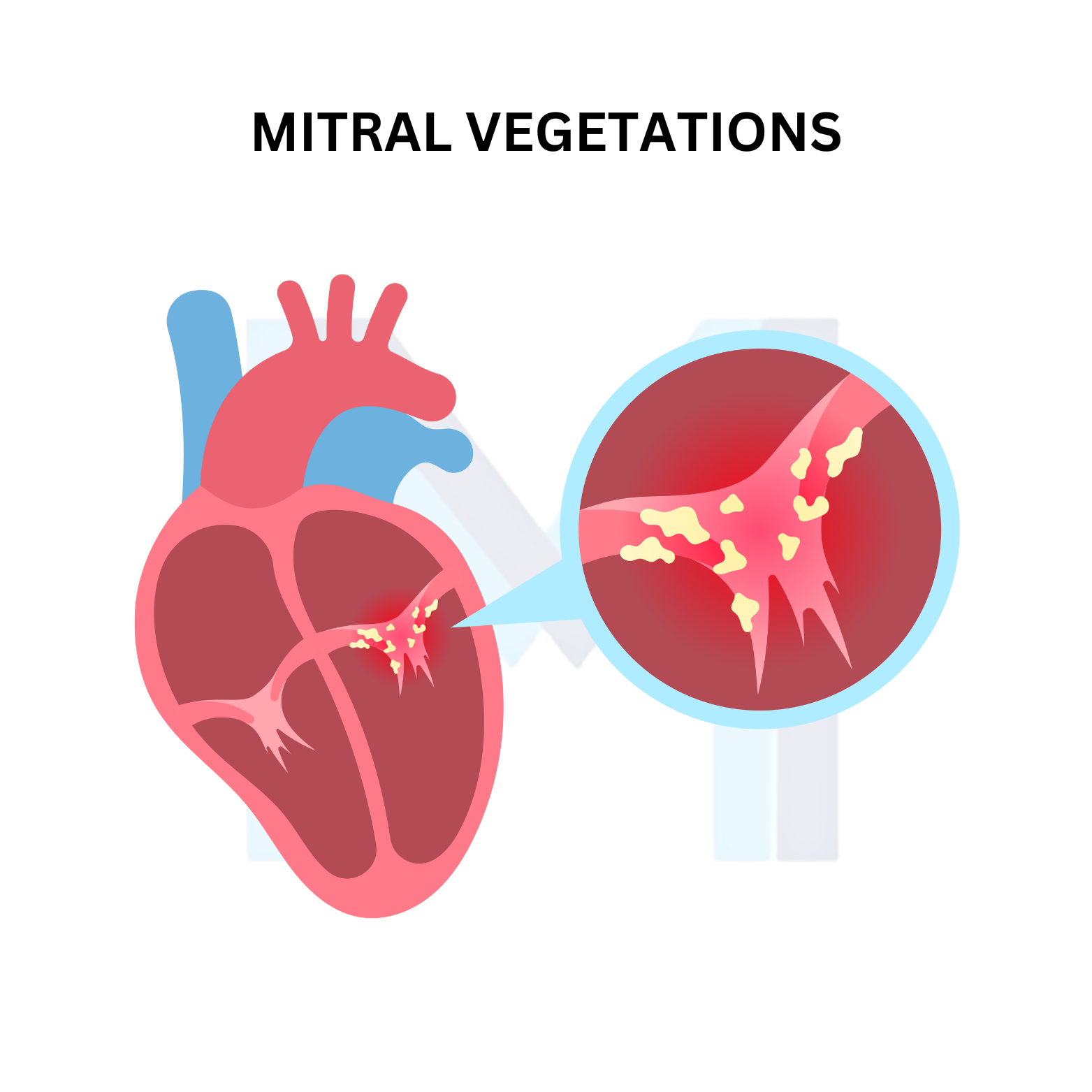 Infective Endocarditis
