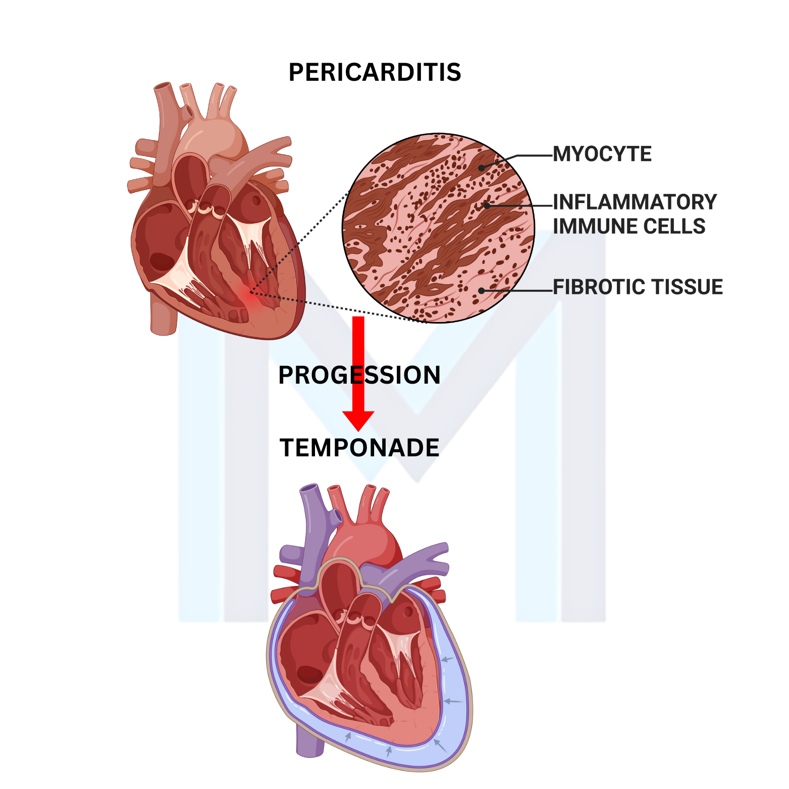 Inflammation of the pericardium with effusion and potential tamponade