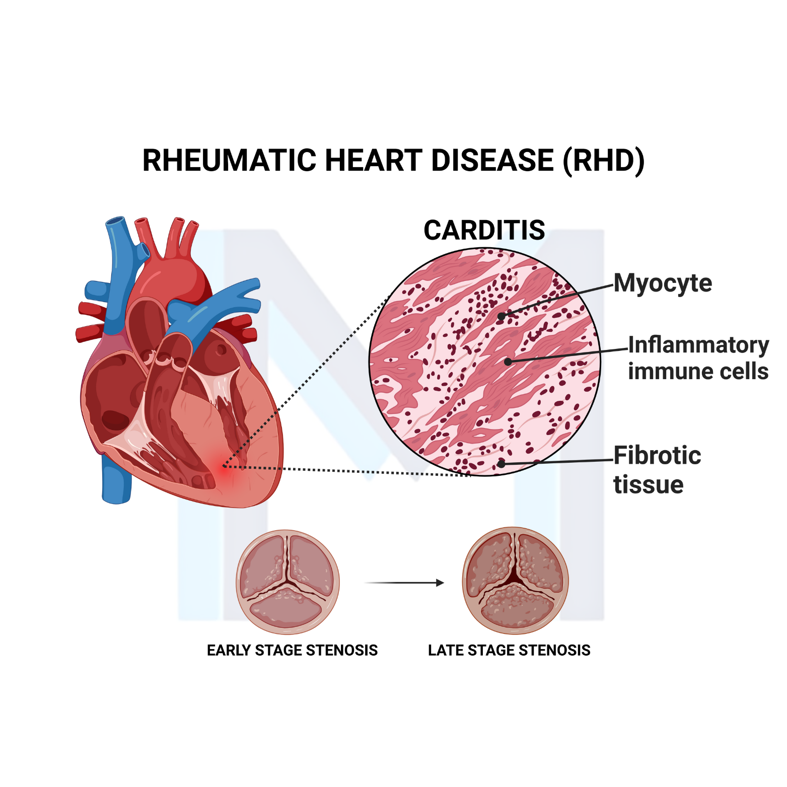 Mitral valve thickening and fusion from rheumatic heart disease