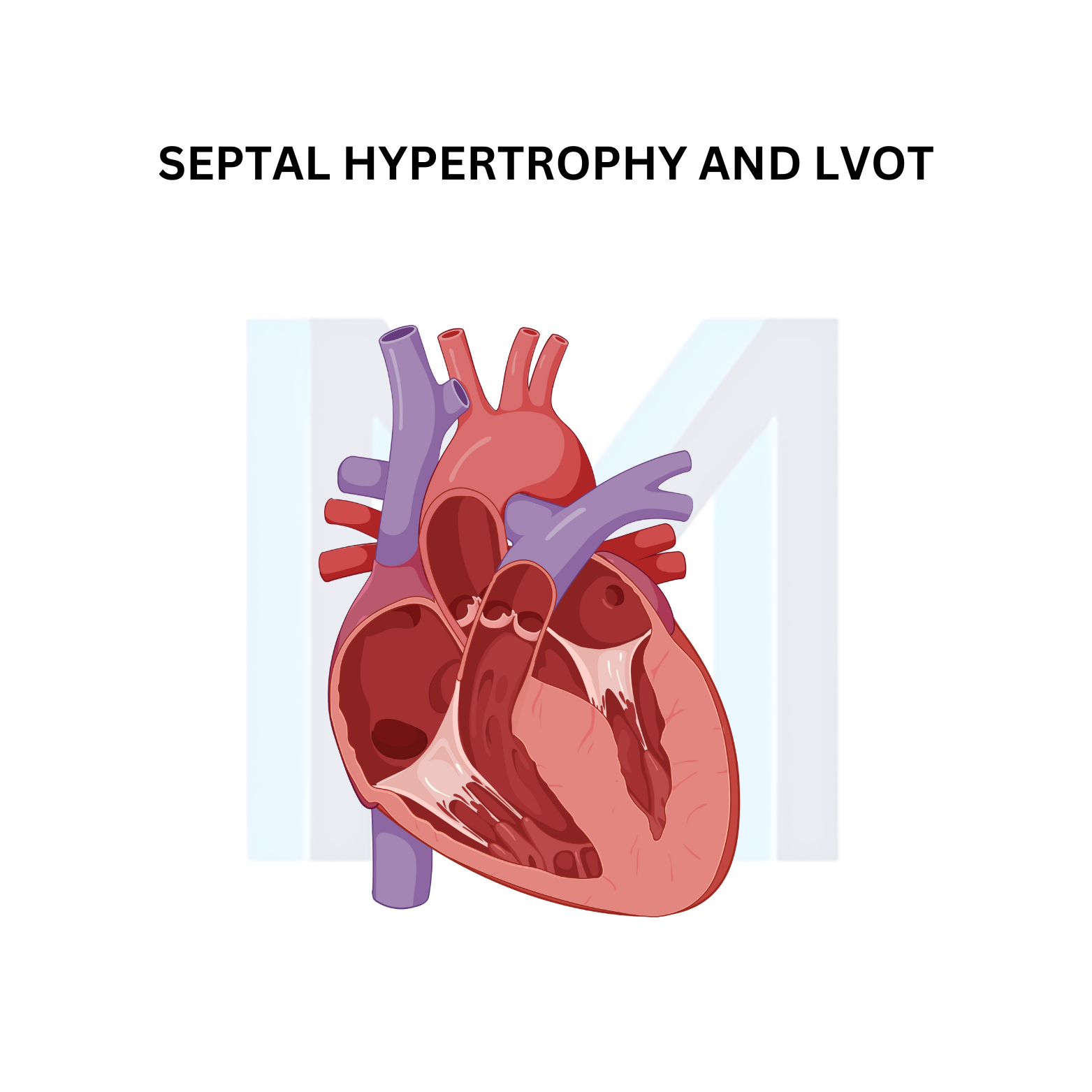 Hypertrophic Cardiomyopathy (HCM)